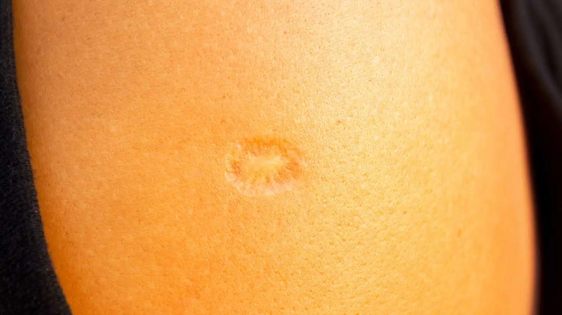 牛痘疫苗可用按壓方式來判別，只要「凹下去，而且有放射狀的線條」就是牛痘的疤痕。（網上圖片）