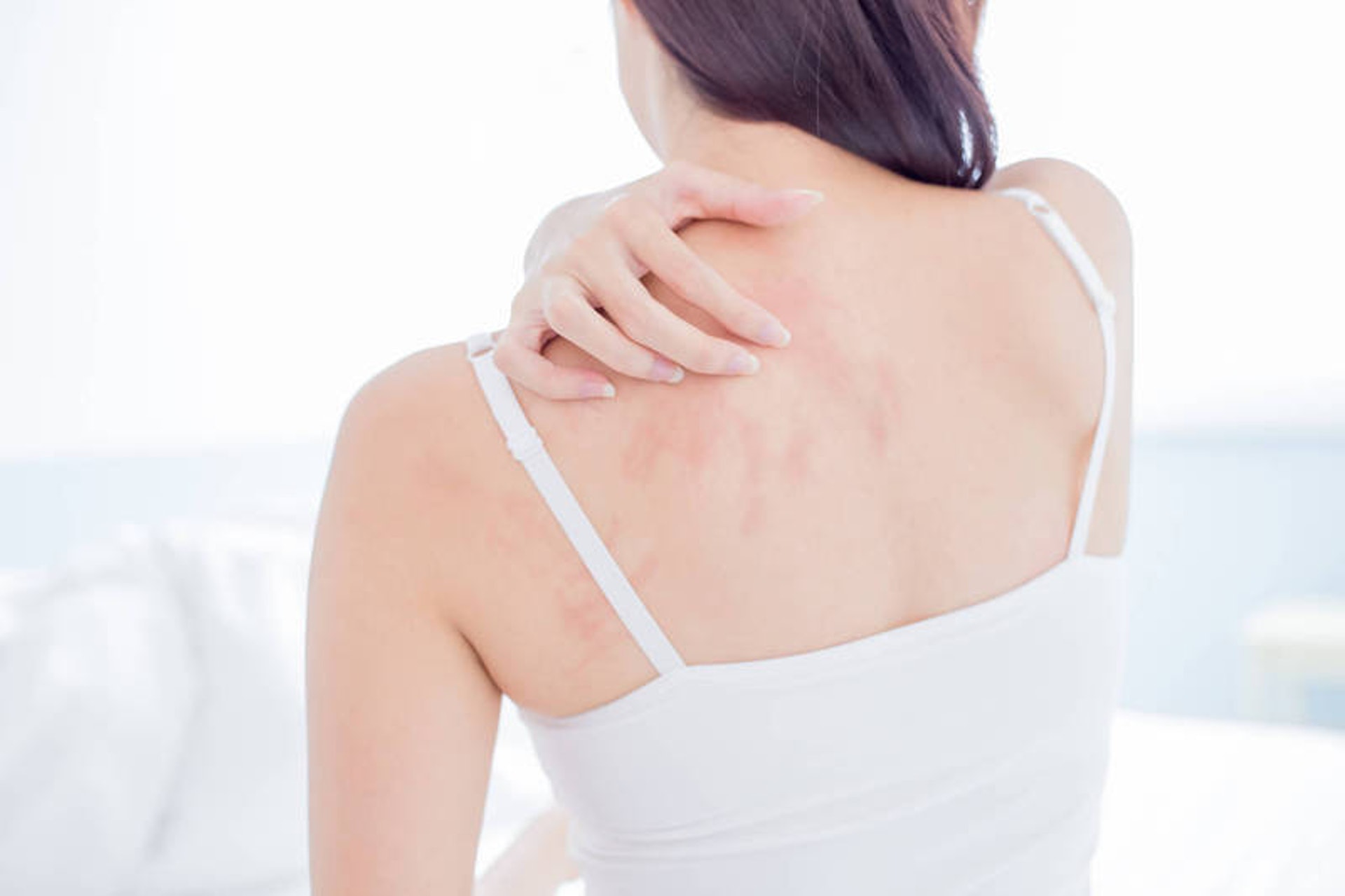 天灸藥貼須敷貼在患者皮膚表面，因此當皮膚有破損或皮膚處於較敏感狀態時，便不適宜做天灸，這一點濕疹患者須注意。（圖片：shutterstock）