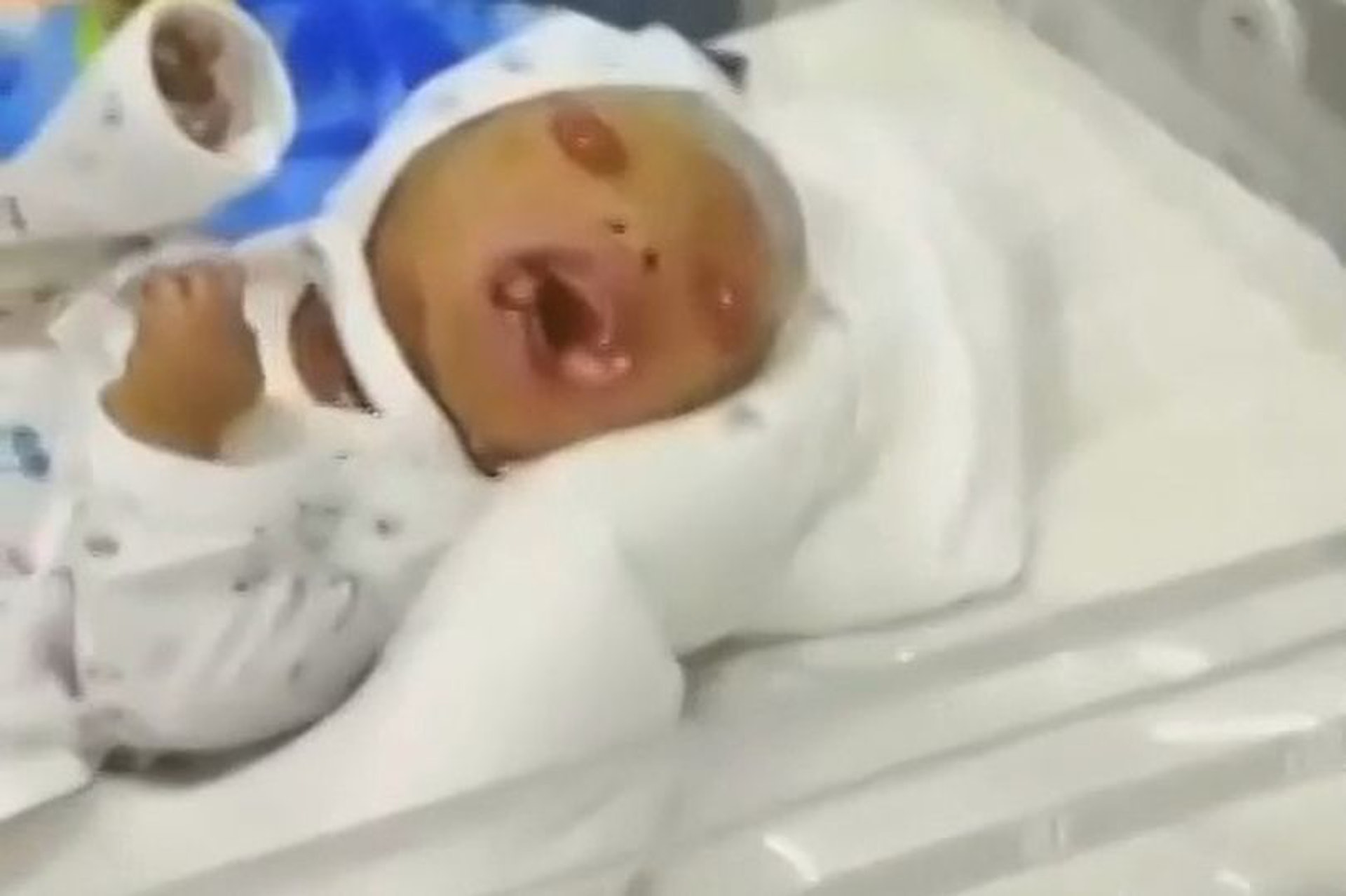 亂倫悲劇 兄妹誕 人魚bb 男嬰全身布滿魚鱗出生2小時慘死 亂倫悲劇 兄妹誕 人魚bb 男嬰全身布滿魚鱗出生2小時慘死