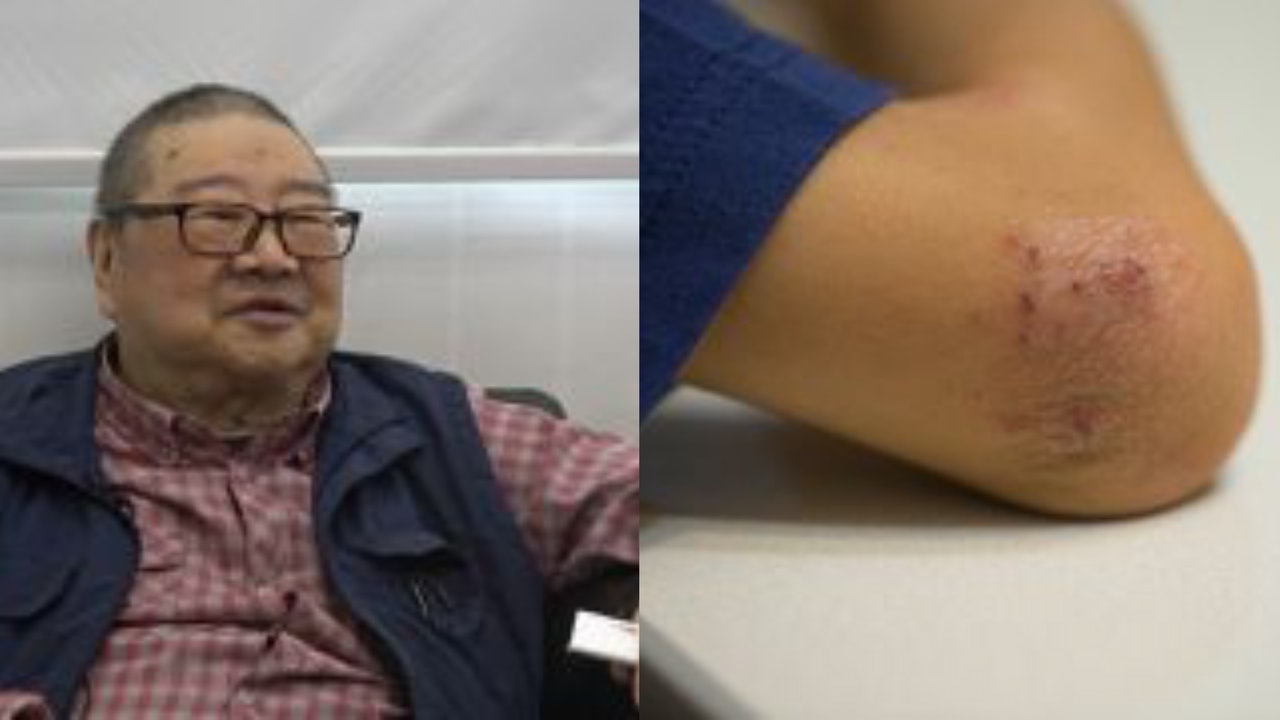 倪匡離世|倪匡身患多個疾病 患皮膚癌唔肯去做化療:死咗一大半 倪匡離世|倪匡身患多個疾病 患皮膚癌唔肯去做化療:死咗一大半