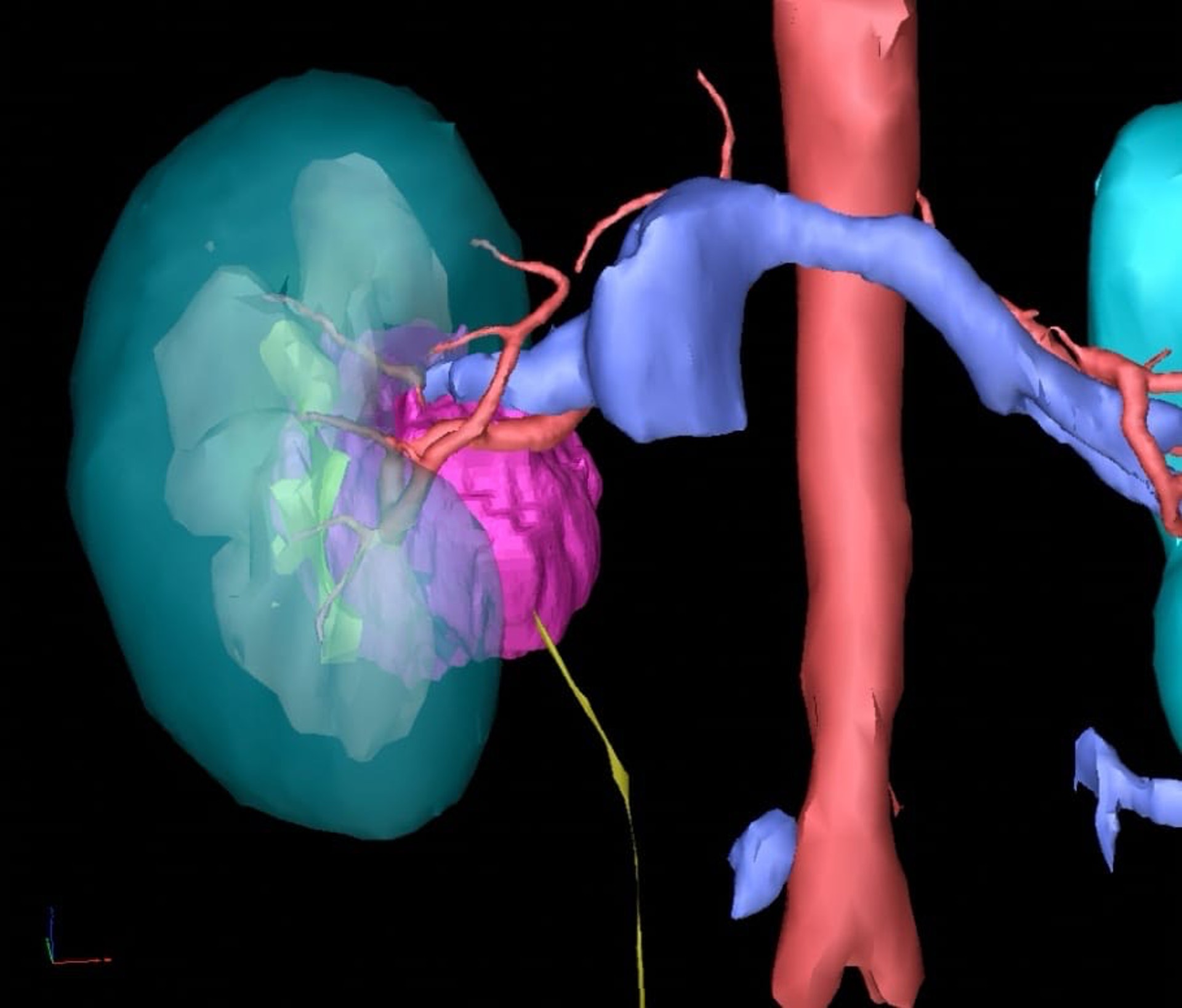 醫生會在手術前利用電腦掃描三維重建技術分析腫瘤與周邊血管組織的關係，圖中紫色部分為腫瘤位置。