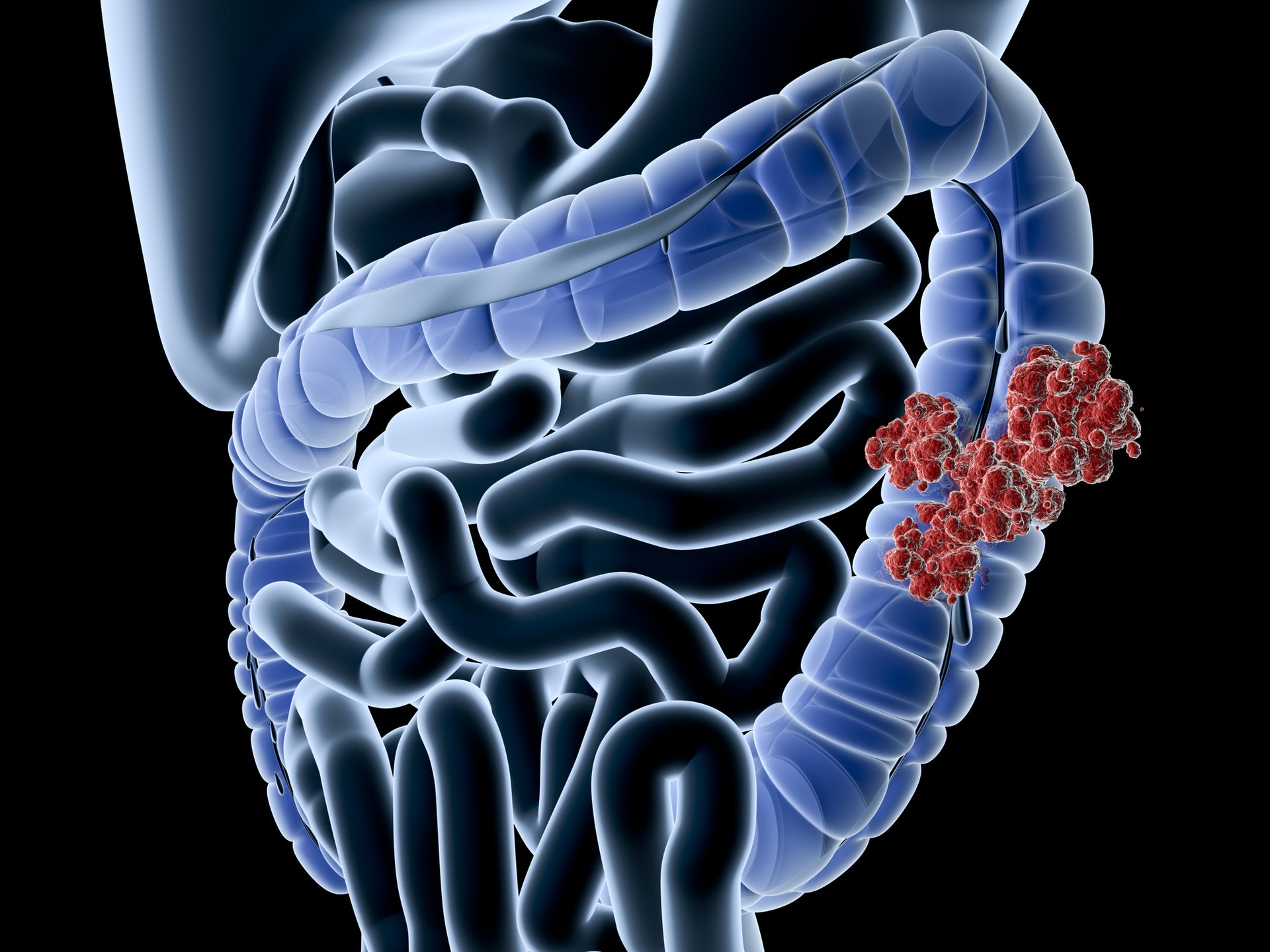 大腸癌有6項常見症狀要注意。（gettyimages）