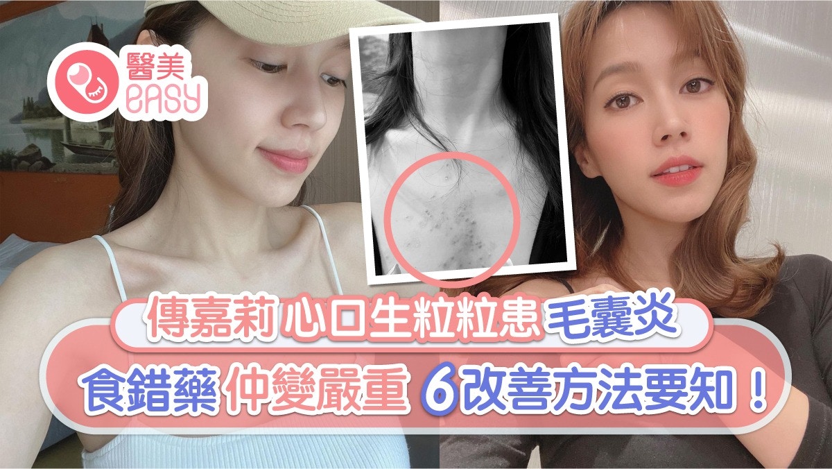 毛囊炎｜傅嘉莉心口生粒粒食錯藥變嚴重  5大成因自行剃毛易出事