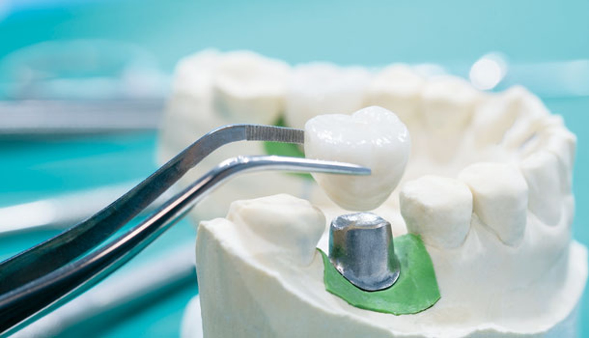 杜牙根後如果沒有造保護牙套，會增加牙齒缺失風險。（圖片：hkalive）