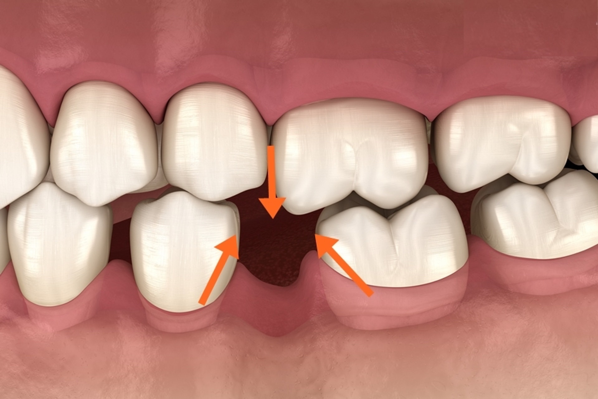 牙齒缺失令牙齒之間留下巨大空隙，不處理的話，長遠會導致牙齒移位，影響咬合。（圖片：istock）