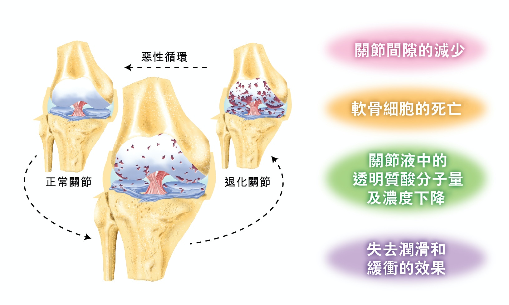 改善長期膝頭哥痛可注射雙分子量透明質酸紓緩痛楚