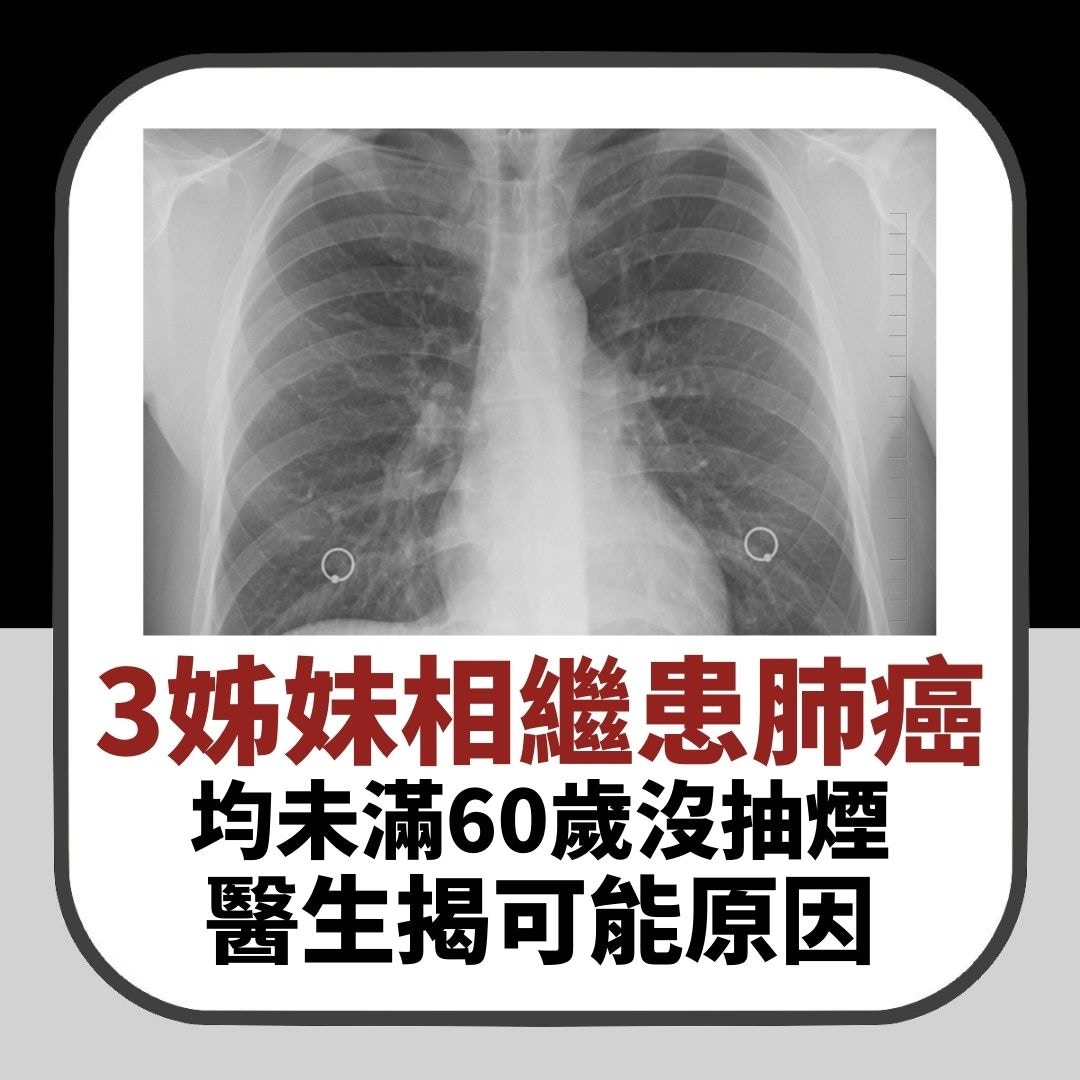 浙江3姊妹同1年內相繼患肺癌　均未滿60歲沒抽煙　醫生揭可能原因（01製圖）