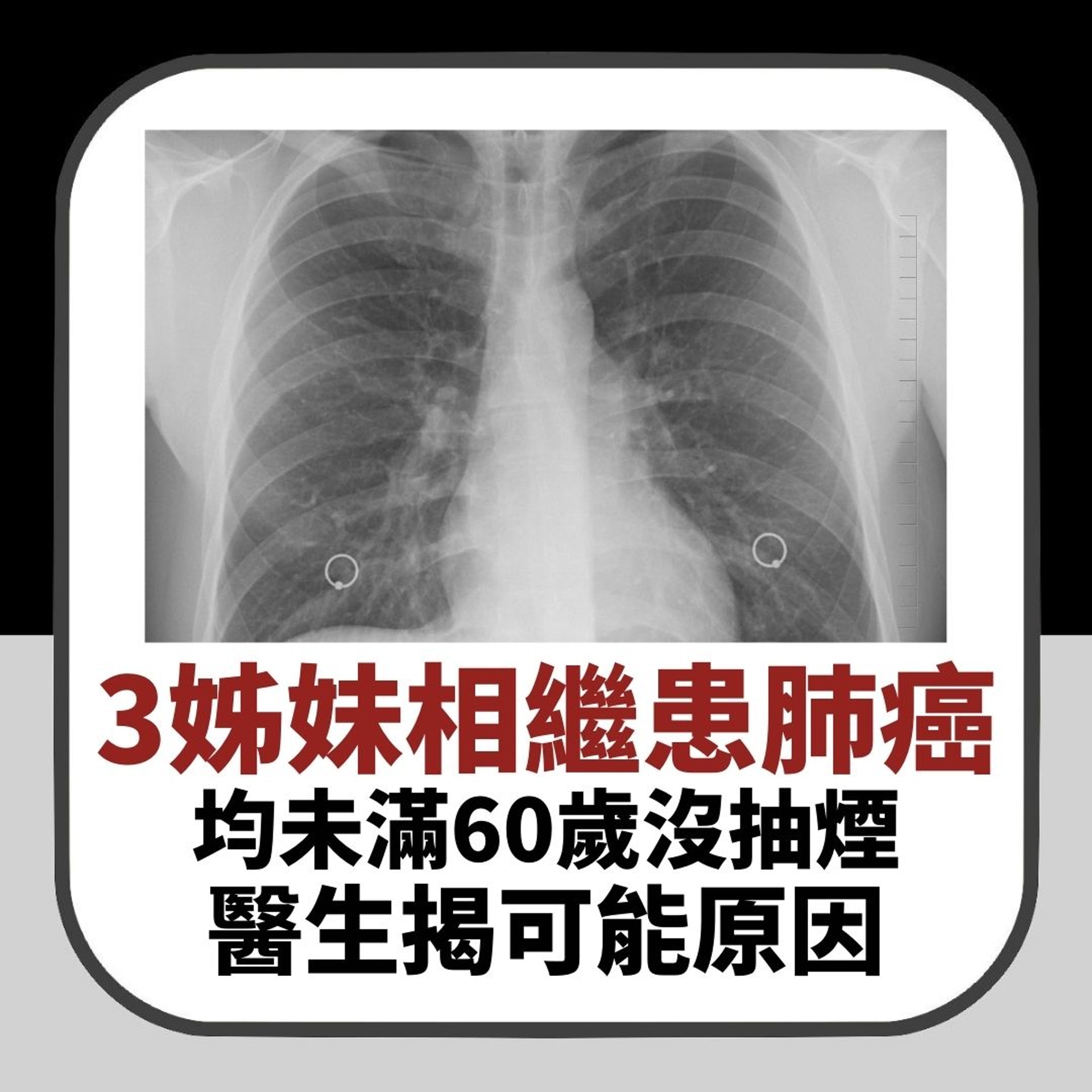 【同場加映】三姊妹一年內相繼患肺癌　均未滿60歲沒抽煙　由同一個醫生治療（01製圖）