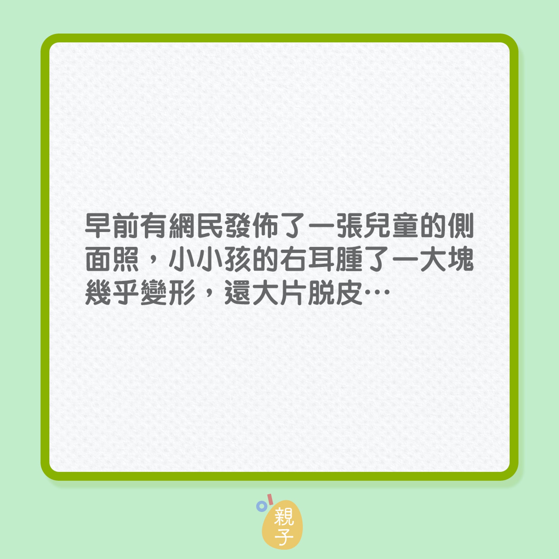 驅蚊|孩子耳殳被蚊咬,腫到變史力加?(01製圖) 驅蚊|孩子耳殳被蚊咬,腫到變史力加?(01製圖)