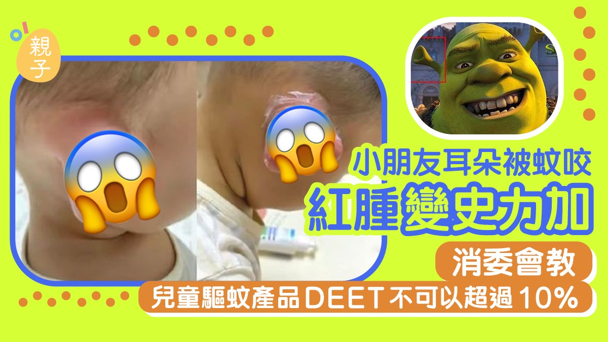 驅蚊|孩子耳朵被蚊咬 紅腫得超誇張 毒舌網民笑指變咗史力加 驅蚊|孩子耳朵被蚊咬 紅腫得超誇張 毒舌網民笑指變咗史力加
