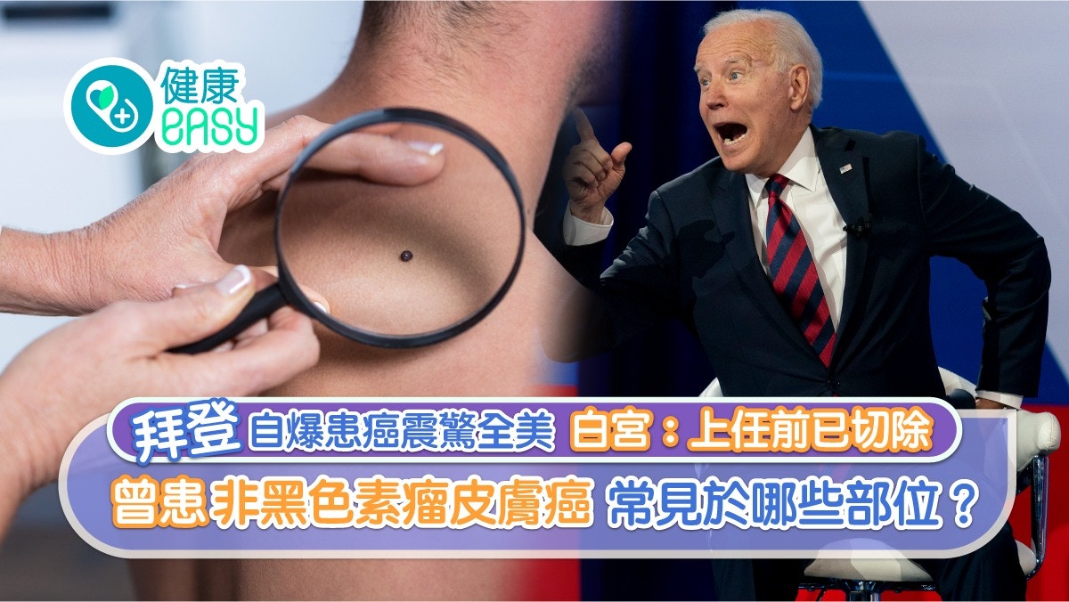 皮膚癌｜拜登自爆患癌白宮急澄清 曾患非黑色素瘤 常見於哪部位？