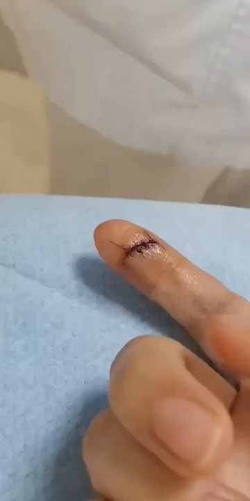 张小泉再爆拍蒜断刀！珠海女刀断割手指血溅满地，缝4针获赔417元（视频/组图） - 2