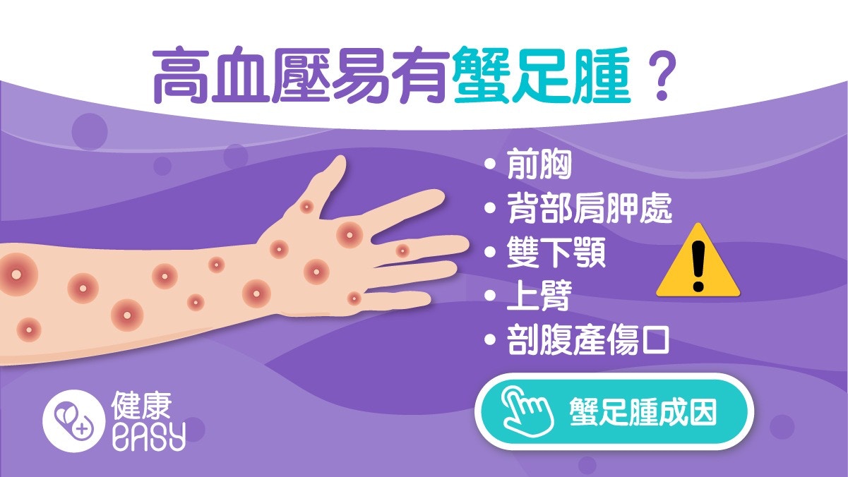 蟹足腫｜紅腫痕癢蟹足腫最常出現在這5大部位　好發於高血壓族群