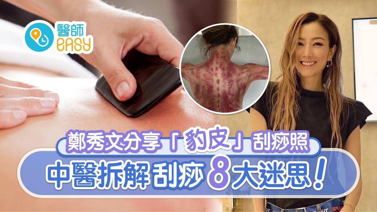 刮痧｜鄭秀文刮痧除疲勞背如豹皮紅就好？治感冒鼻敏感4部位勿刮!