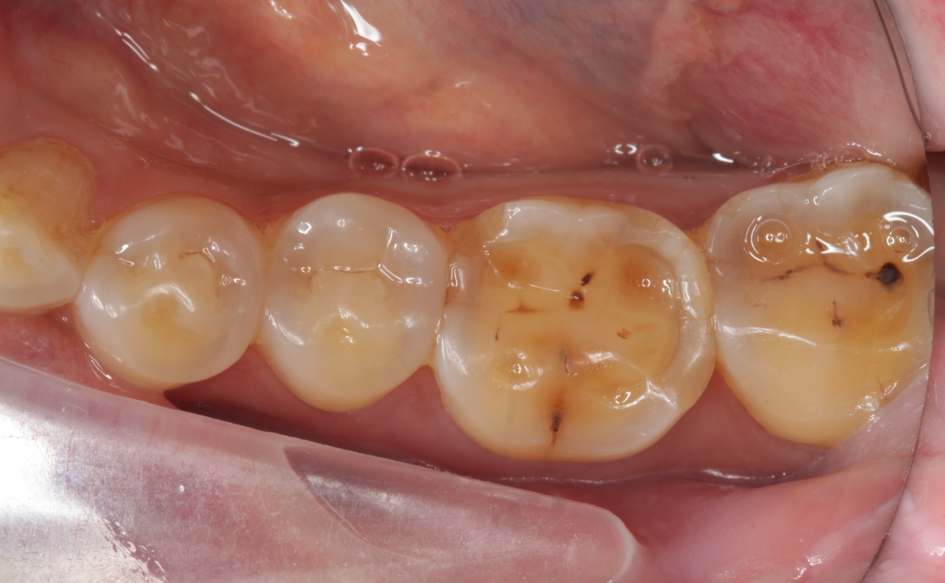口腔內牙齒侵蝕情況，牙齒中央位置凹陷。