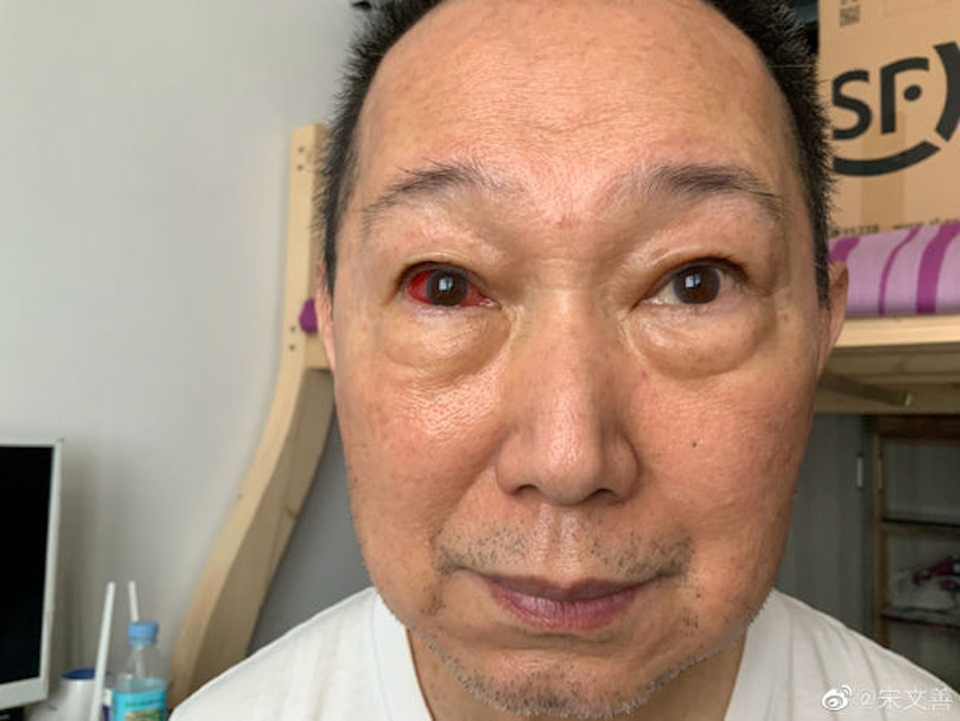 宋文善7月中旬才稱因高血壓而令眼球出血。(微博 / @宋文善) 宋文善7月中旬才稱因高血壓而令眼球出血。(微博 / @宋文善)