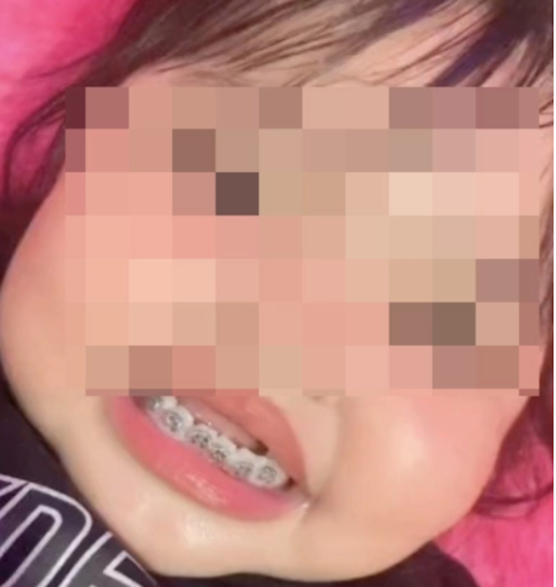 3歲女童被迫戴箍牙狀甚痛苦網民轟母虐兒牙醫倡幾歲可矯齒? 3歲女童被迫戴箍牙狀甚痛苦網民轟母虐兒牙醫倡幾歲可矯齒?