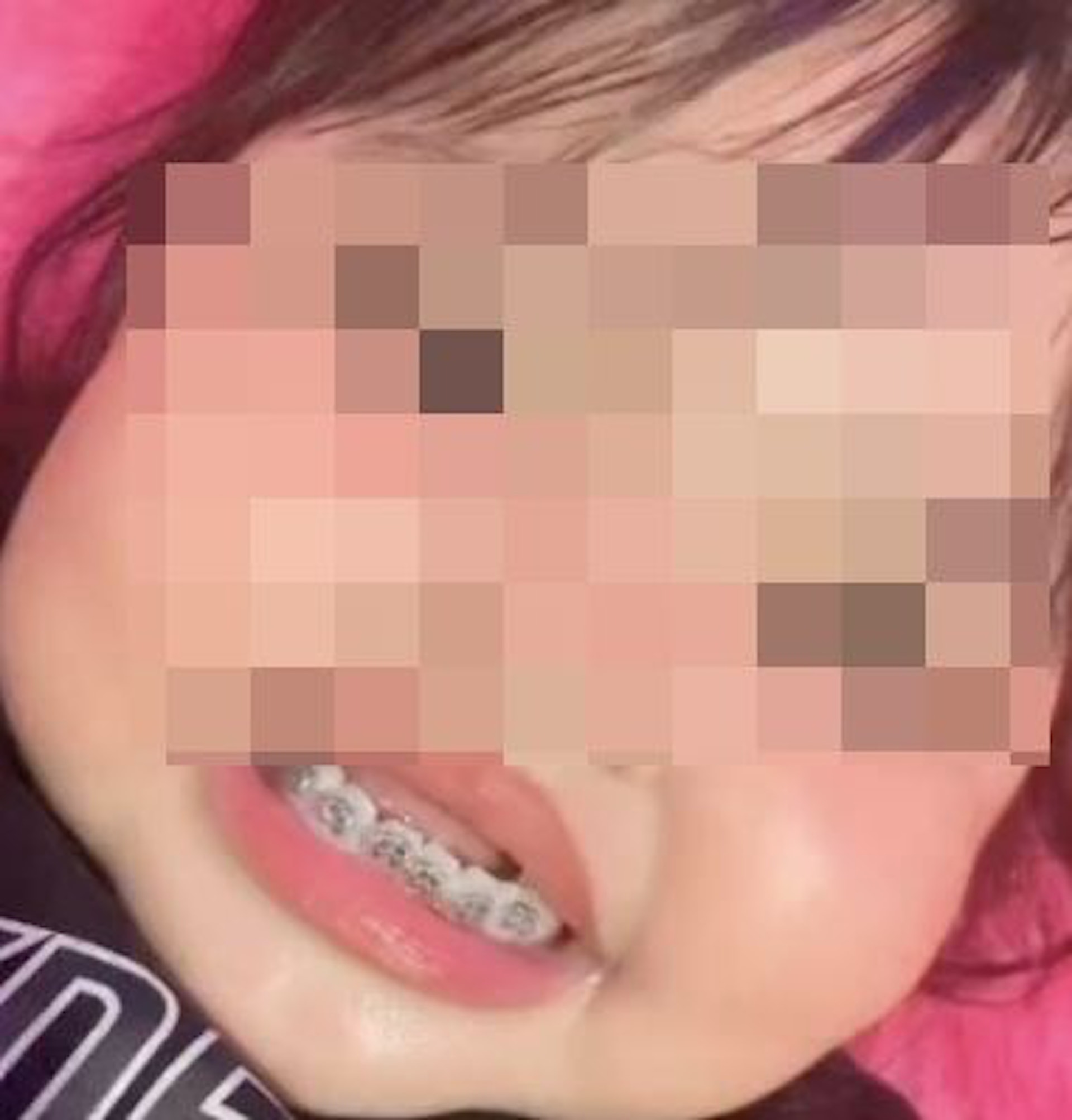 涉事3歲女童的下排乳齒被戴上一排銀灰色牙箍，表情狀甚痛苦。（網上圖片）