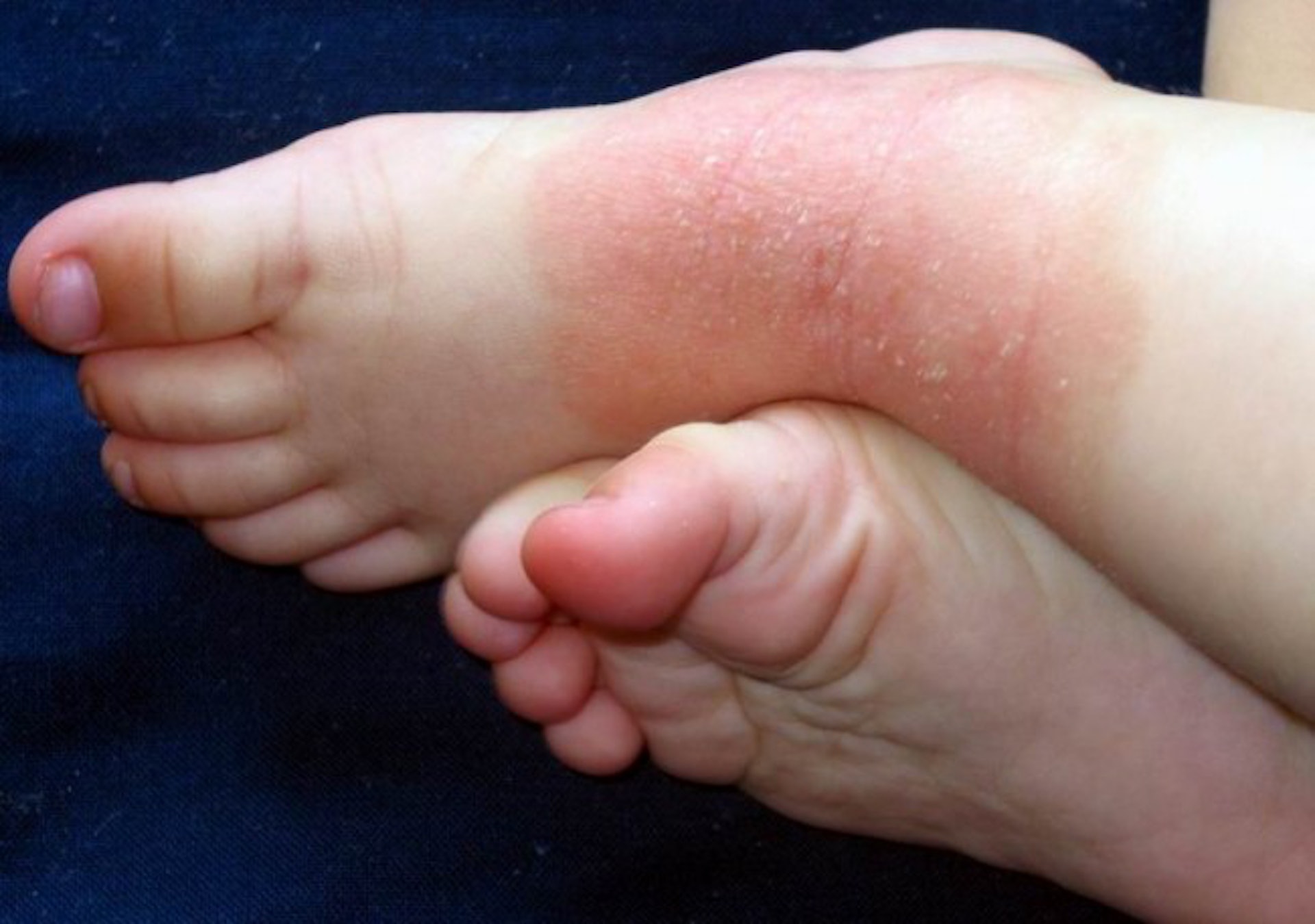 濕疹在香港頗為常見，而皮膚幼嫩的嬰幼兒出現濕疹的話，更令父母十分痛心。（圖片：Wikimedia）
