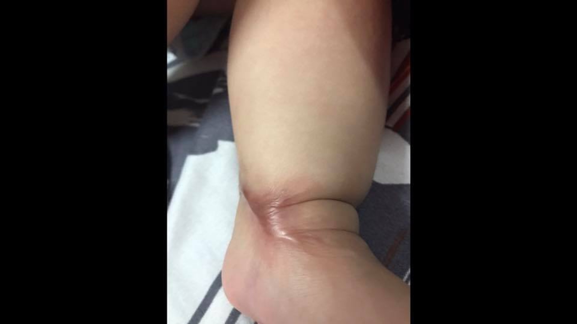在接受手術後，小Teh冰的腳踝竟腫得很厲害，據醫生的說法是，因為插管注射營養液，然後營養液滯留在腳踝裏導致發炎。（Facebook / @小Teh冰不一樣的勇敢日記）