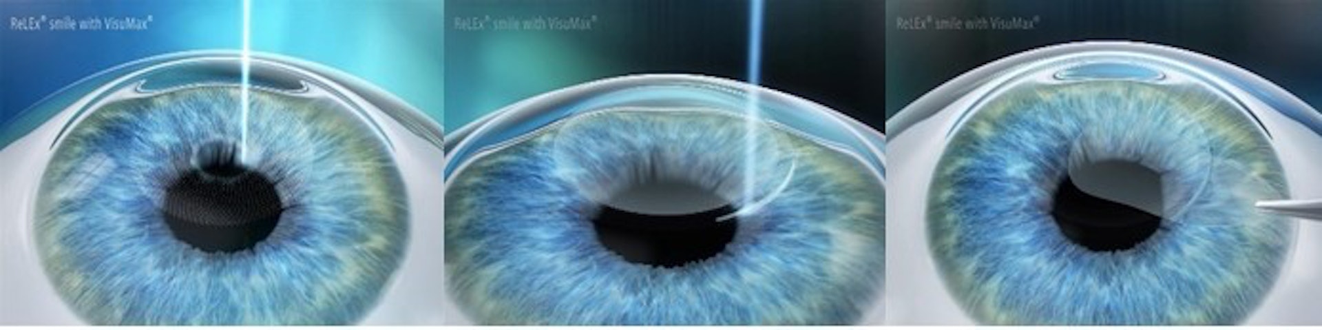 SMILE微笑矯視技術透過飛秒激光系統(Carl Zeiss VisuMax)切割角膜中層部分,令角膜弧度改變,再從2至4毫米的小切口把膜片取出,以達到視力矯正的效果。(圖片:清晰微笑激光矯視中心) SMILE微笑矯視技術透過飛秒激光系統(Carl Zeiss VisuMax)切割角膜中層部分,令角膜弧度改變,再從2至4毫米的小切口把膜片取出,以達到視力矯正的效果。(圖片:清晰微笑激光矯視中心)