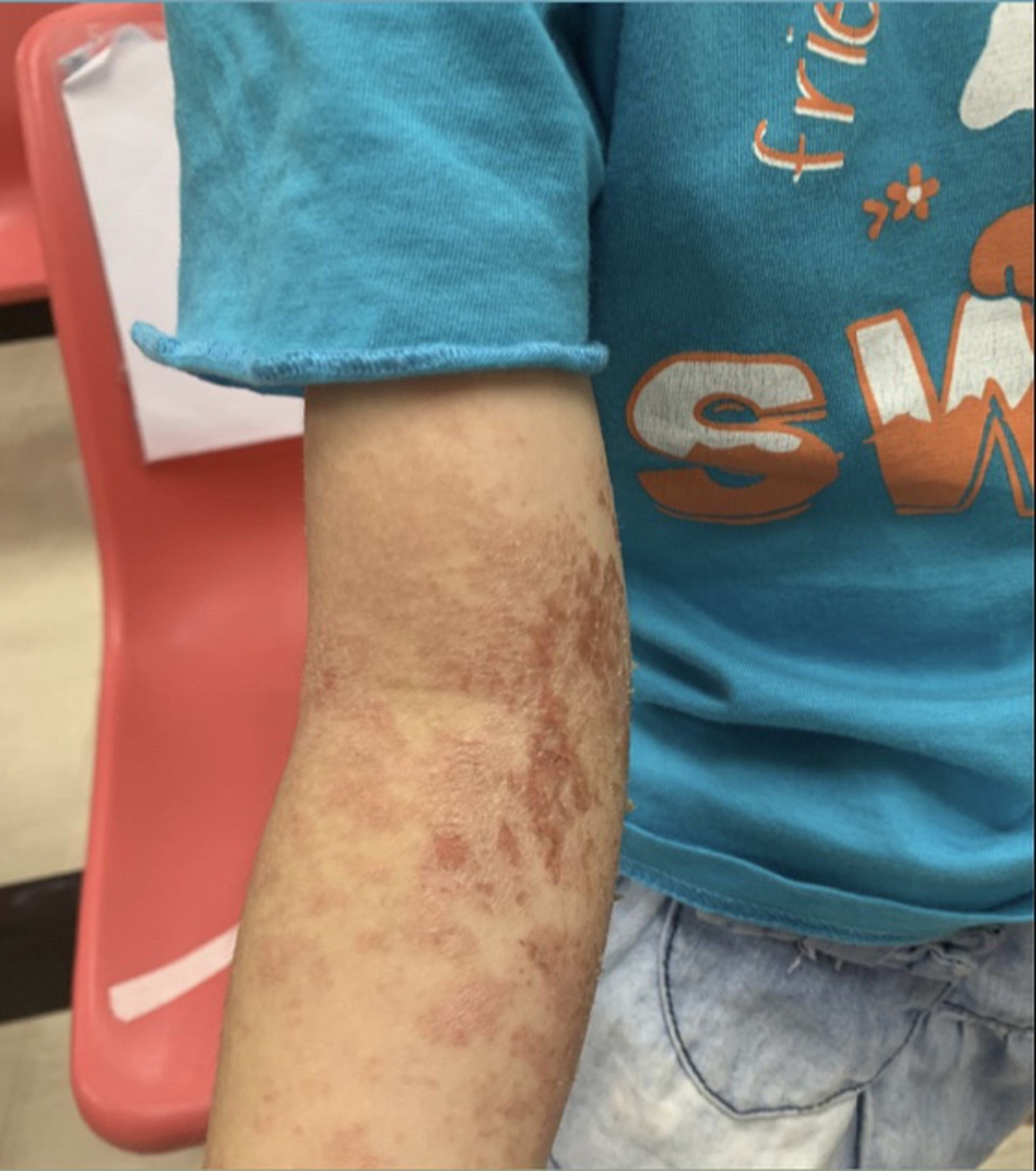 截至8月15日瑪嘉烈醫院共跟進288宗8至13歲的小童長新冠個案，有兒童出現嚴重濕疹。（醫管局提供）