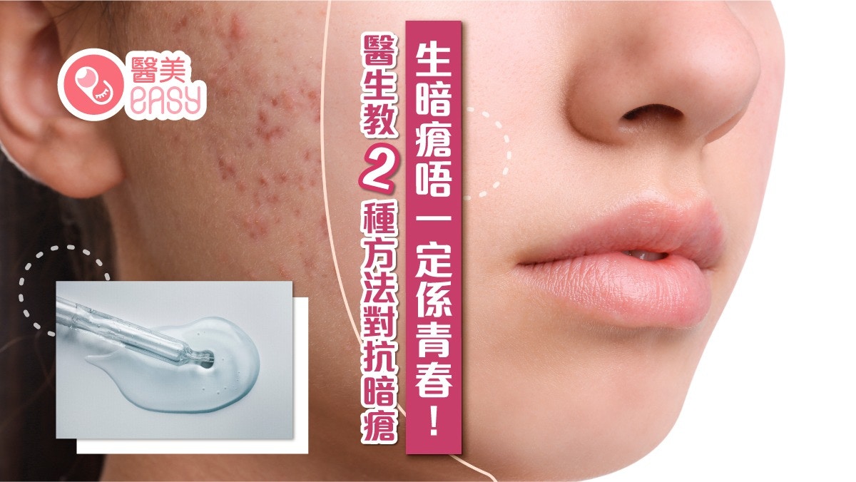 暗瘡｜粉刺含膿發炎2大類要分清　勤洗面或惡化果酸減油脂幾時用?