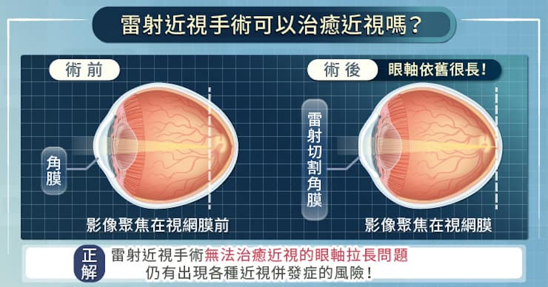 雷射近視手術可以治癒近視嗎？（照護線上授權使用）