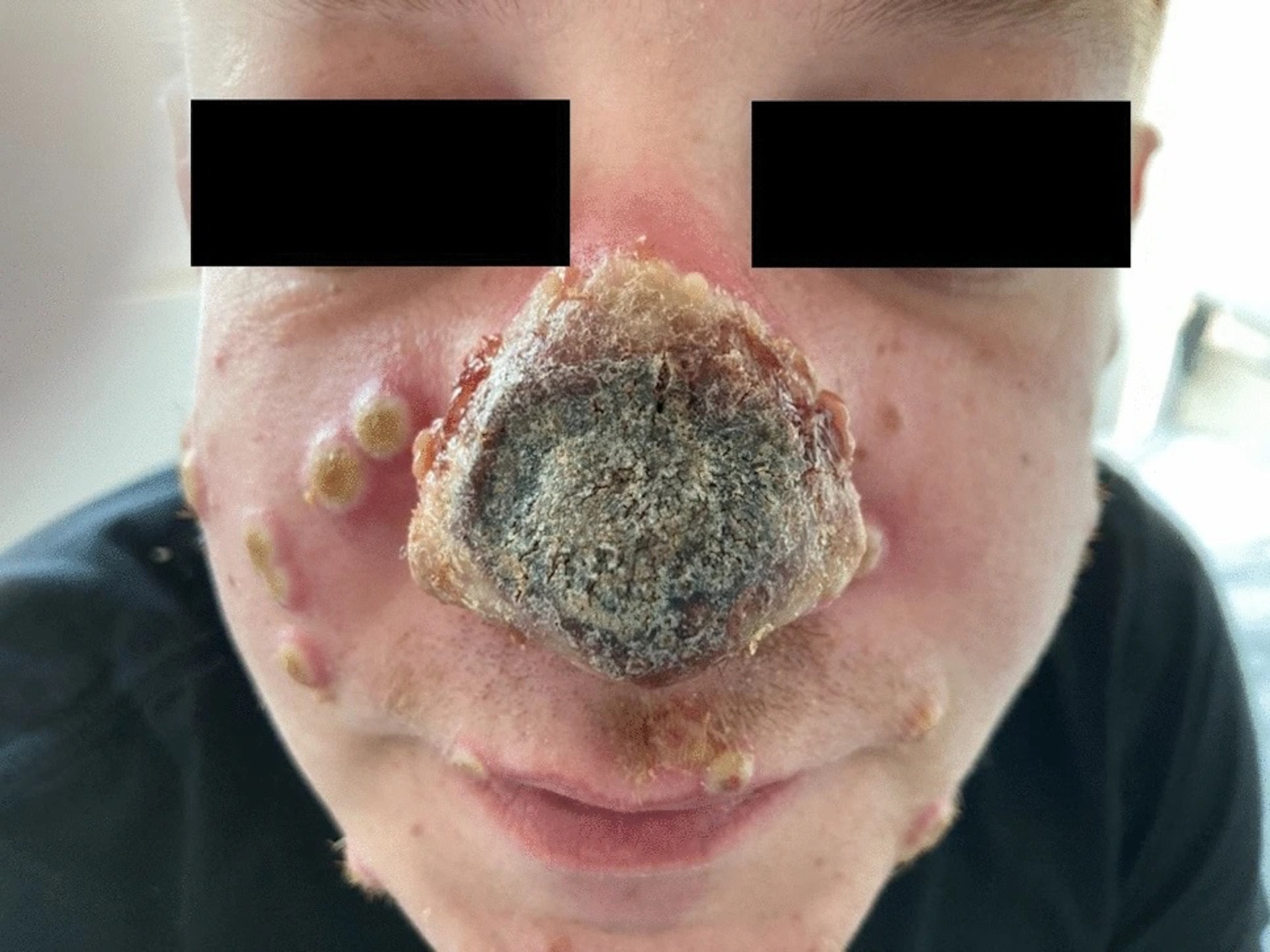 圖為一名猴痘患者臉部的情況，鼻子出現腐爛壞死病變。（Journal of Infection，翻攝自SpringerLink，Christoph Boesecke）
