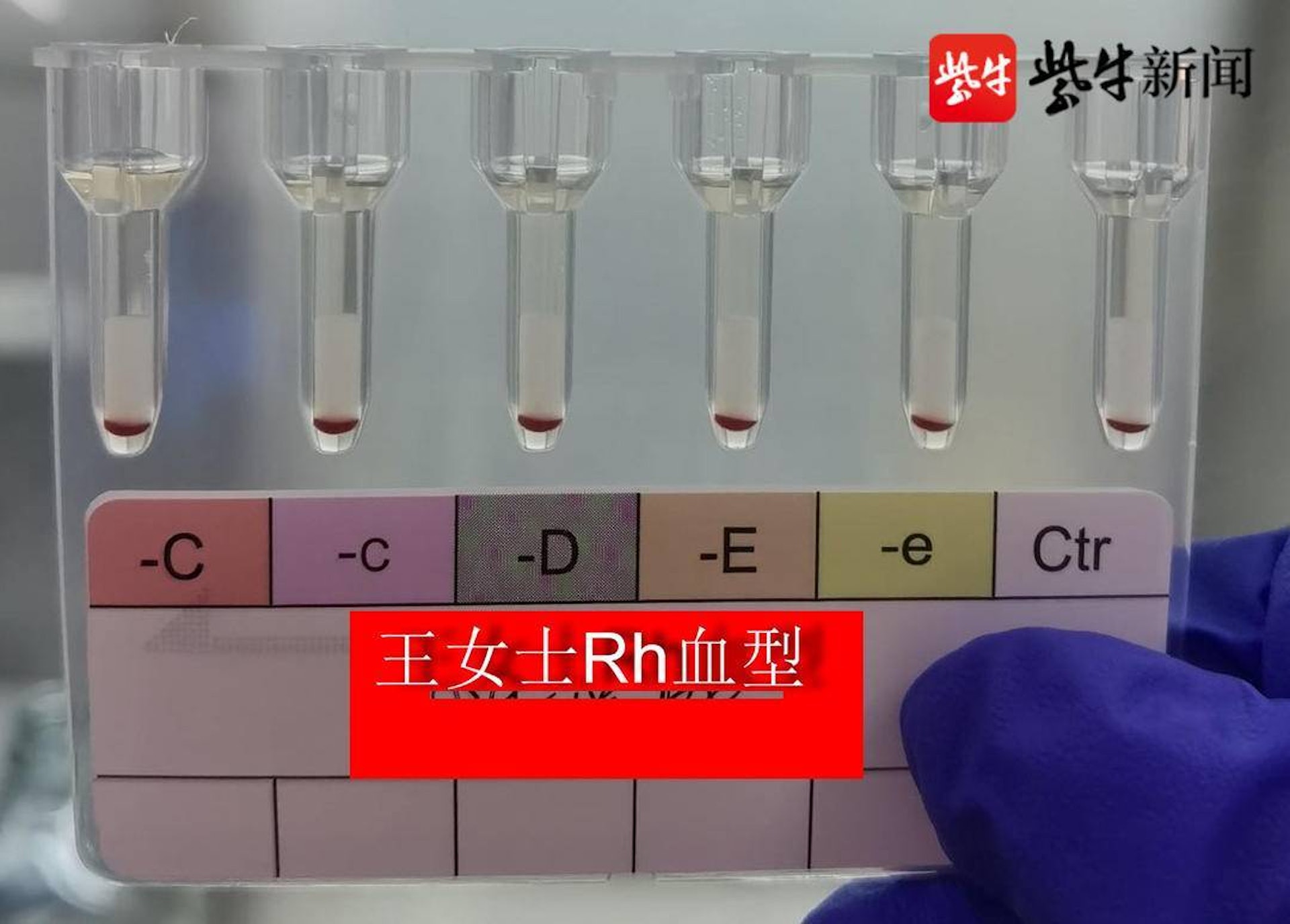 一名患有重度貧血的女子進行血型檢查時發現為全球罕見的黃金血型。（紫牛新聞）