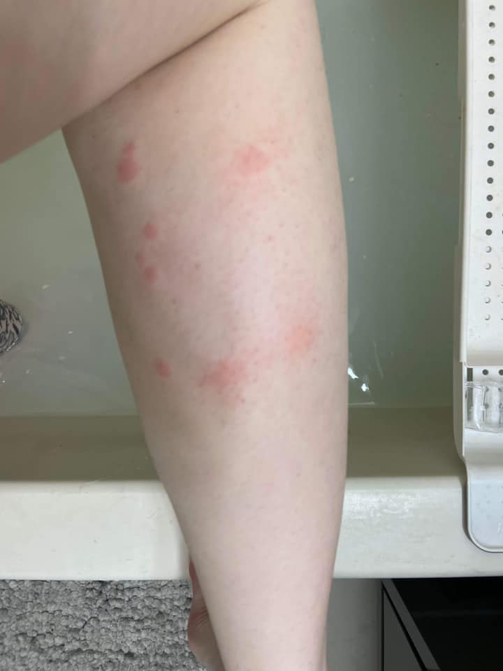 床蝨丨港女staycation疑遭蝨咬到美腿紅腫返家更驚嚇 床有蝨