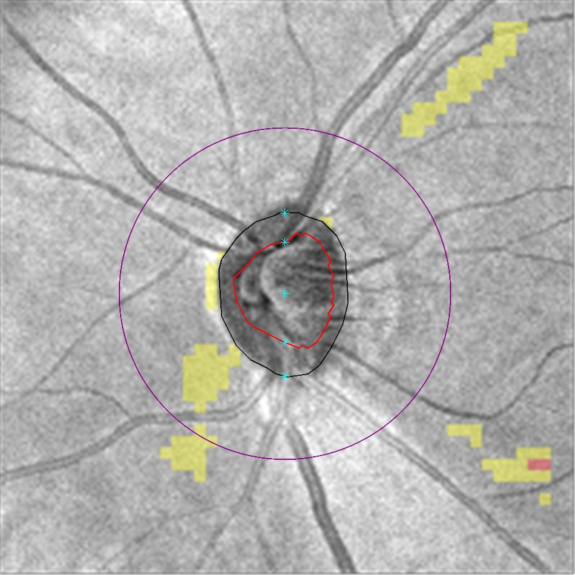 視網膜神經纖維層厚度概率圖。（港大及中大提供）