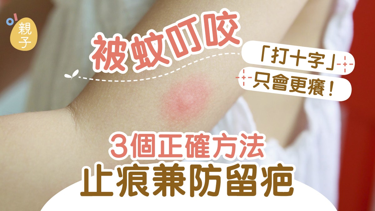 驅蚊|被蚊叮咬「打十字」只會更癢!3個正確方法止痕兼防留疤 驅蚊|被蚊叮咬「打十字」只會更癢!3個正確方法止痕兼防留疤