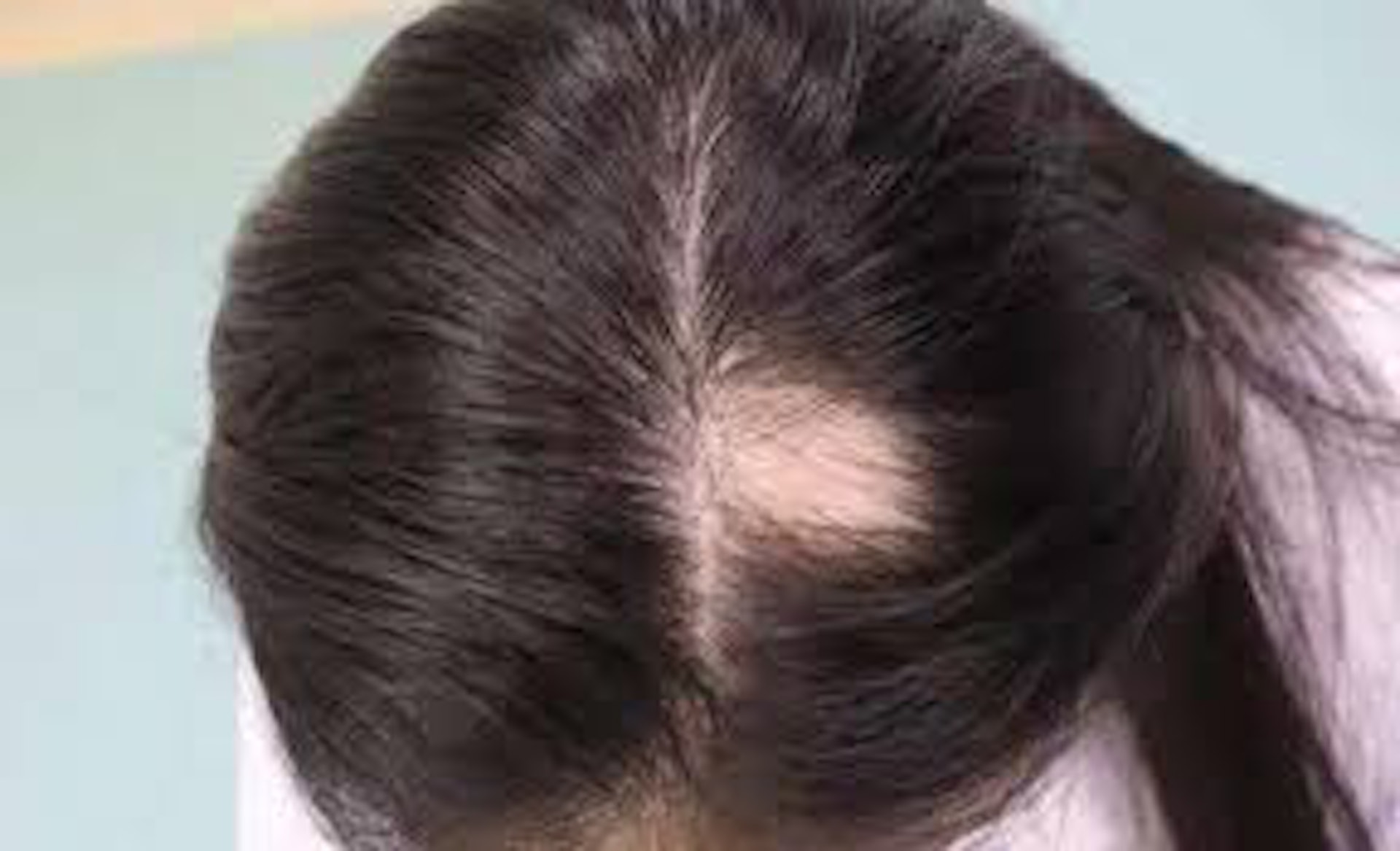 鬼剃頭在醫學上稱為「斑禿」（Alopecia），患者的頭髮突然間會局部性出現一個如5蚊硬幣般大小的禿頂情況，有部分患者甚至在眼睫毛及眉毛位置亦會出現脫髮情況。（網上圖片）