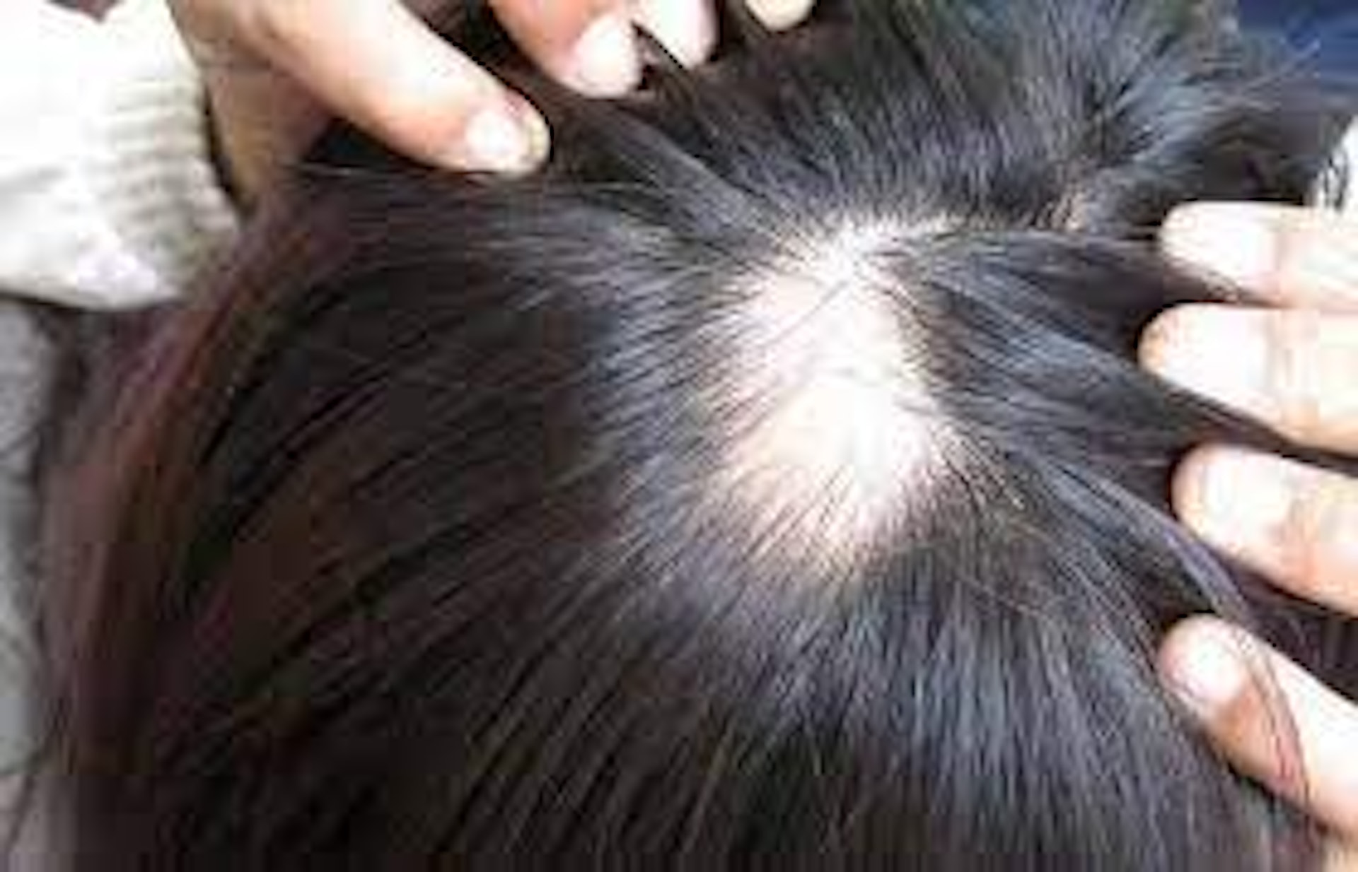 如果鬼剃頭情況不是太嚴重，患者可先採取觀望態度，大部分在幾個月至1年內都能自行痊癒並長出正常頭髮。（網上圖片）