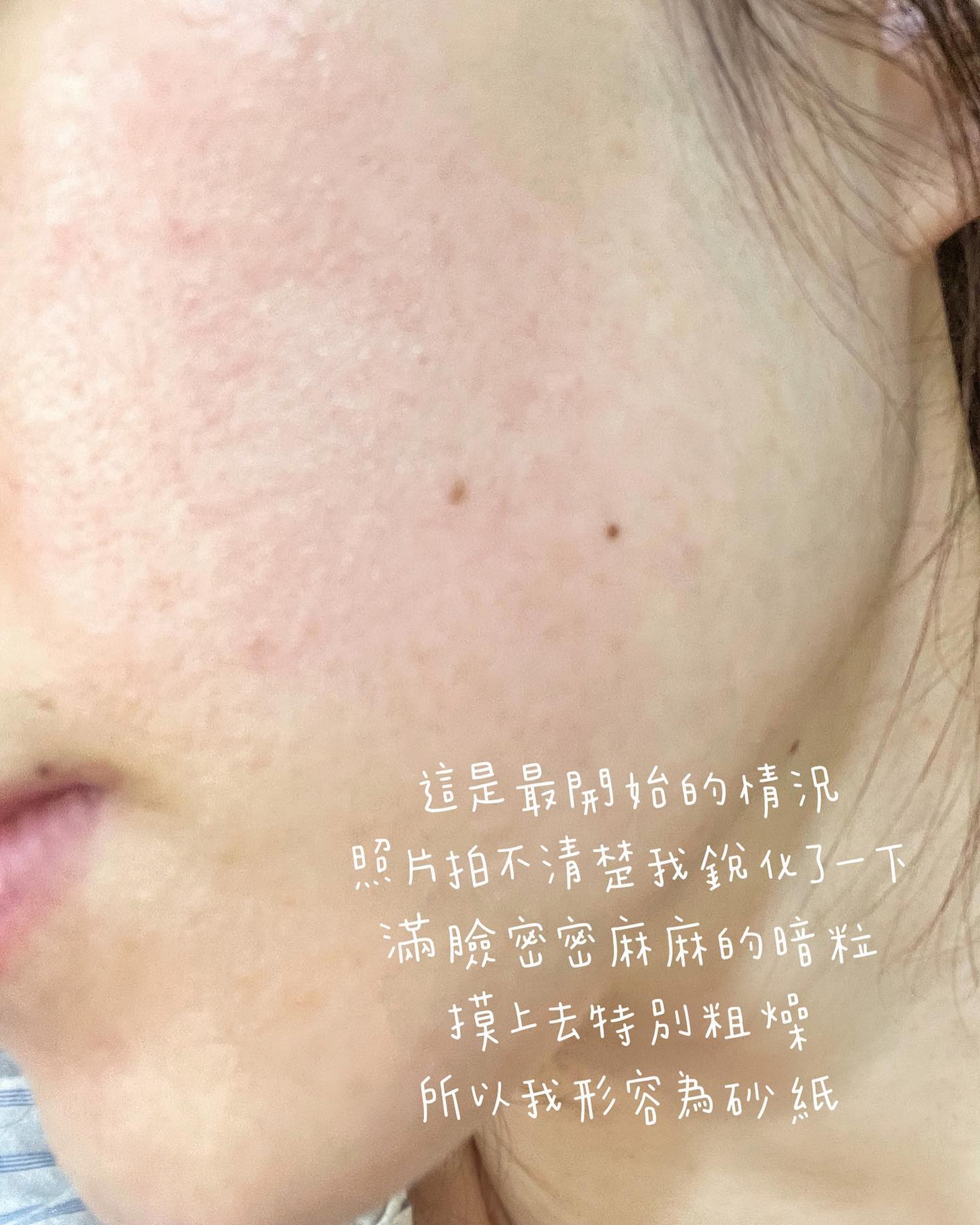 KOL網紅鍾浠文(Zelia)日前就因為忘記清洗Cream Mask導致毛孔堵塞過敏發炎(IG@zelia) KOL網紅鍾浠文(Zelia)日前就因為忘記清洗Cream Mask導致毛孔堵塞過敏發炎(IG@zelia)