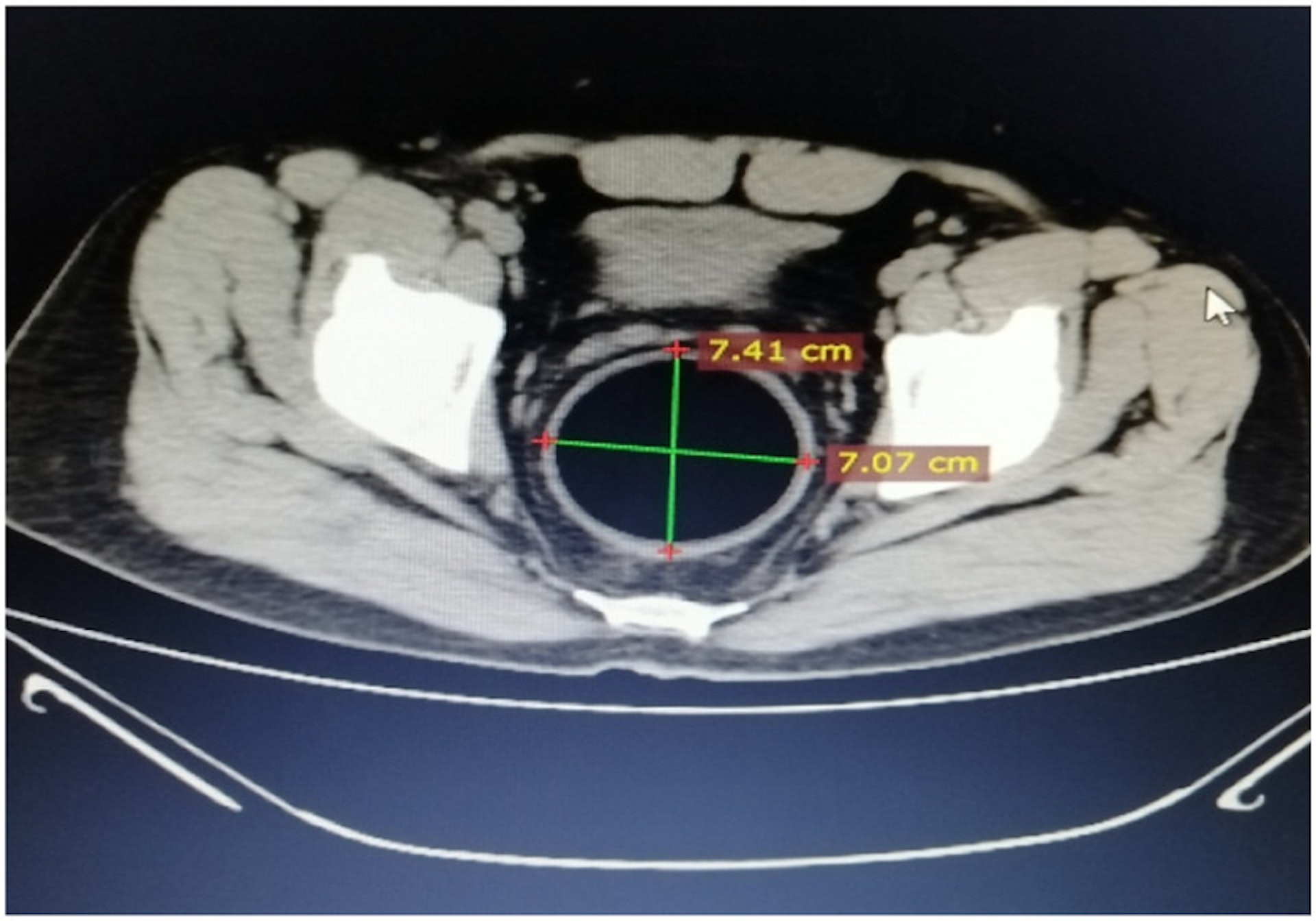 從電腦掃描圖片可看出，該大小約為7厘米乘7厘米的球體已堵住男子直腸。（「International Journal of Surgery Case Reportss」圖片）