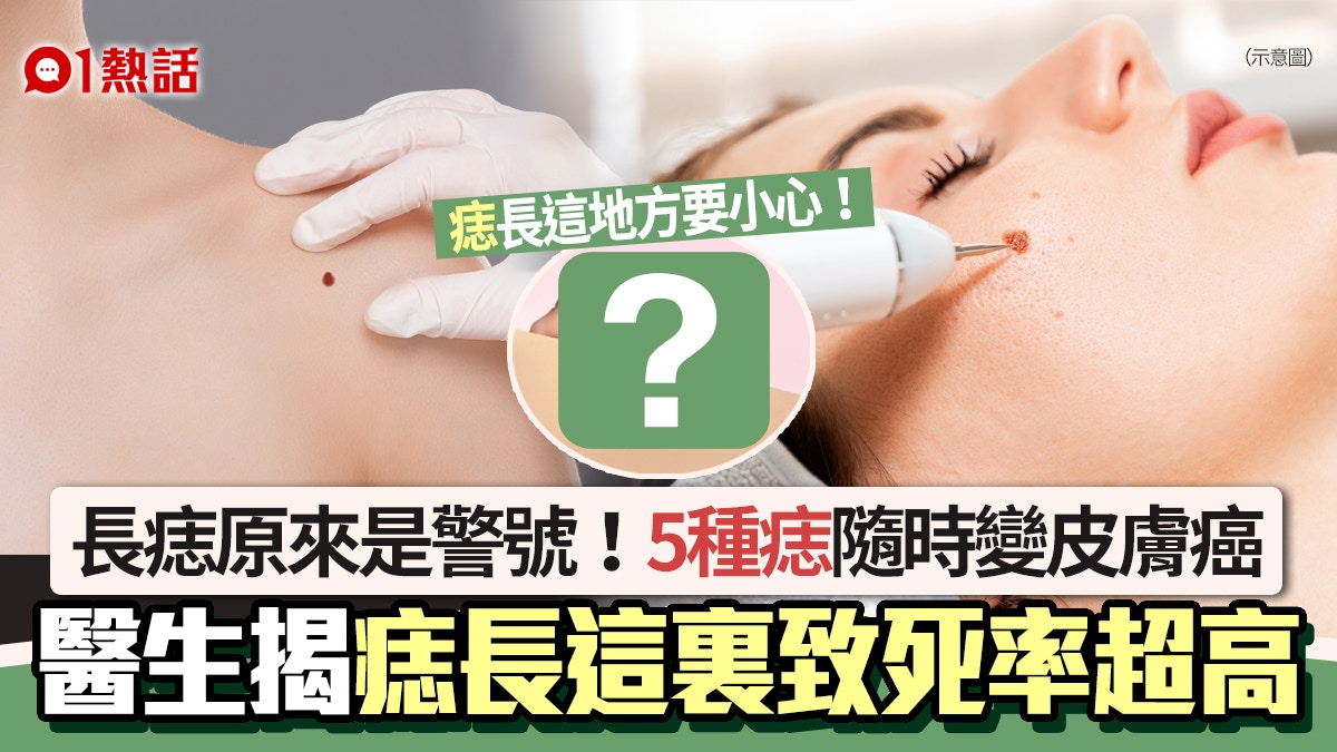 身體長痣是警號！醫生揭痣長這裏致死率超高　5種痣隨時變皮膚癌