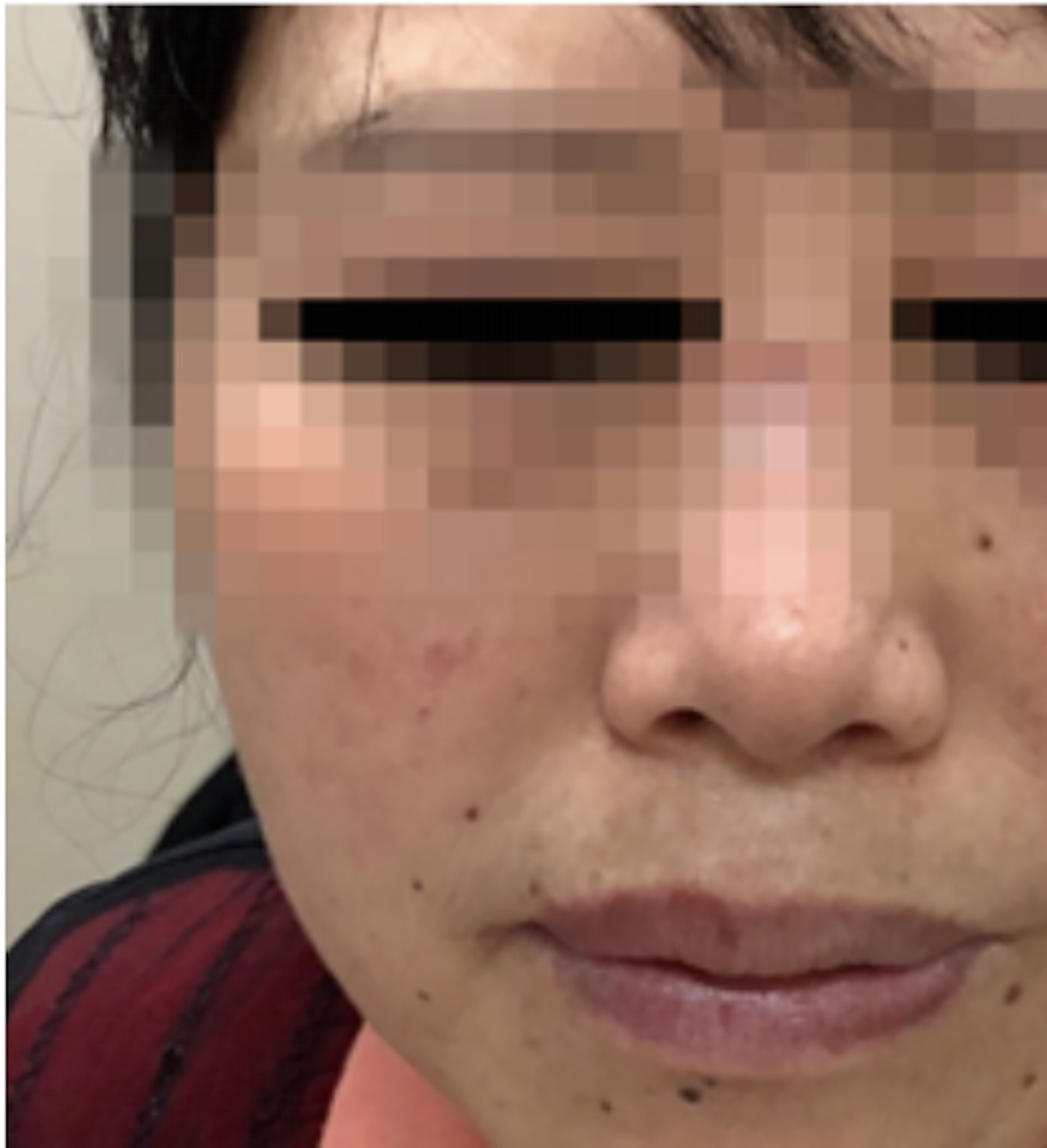 內地1名54歲女子早前陪友人到醫院看皮膚科時，醫生對其臉上的痣感奇怪，並幫她進一步檢查，結果證實是最常見的惡性腫瘤。（網上圖片）