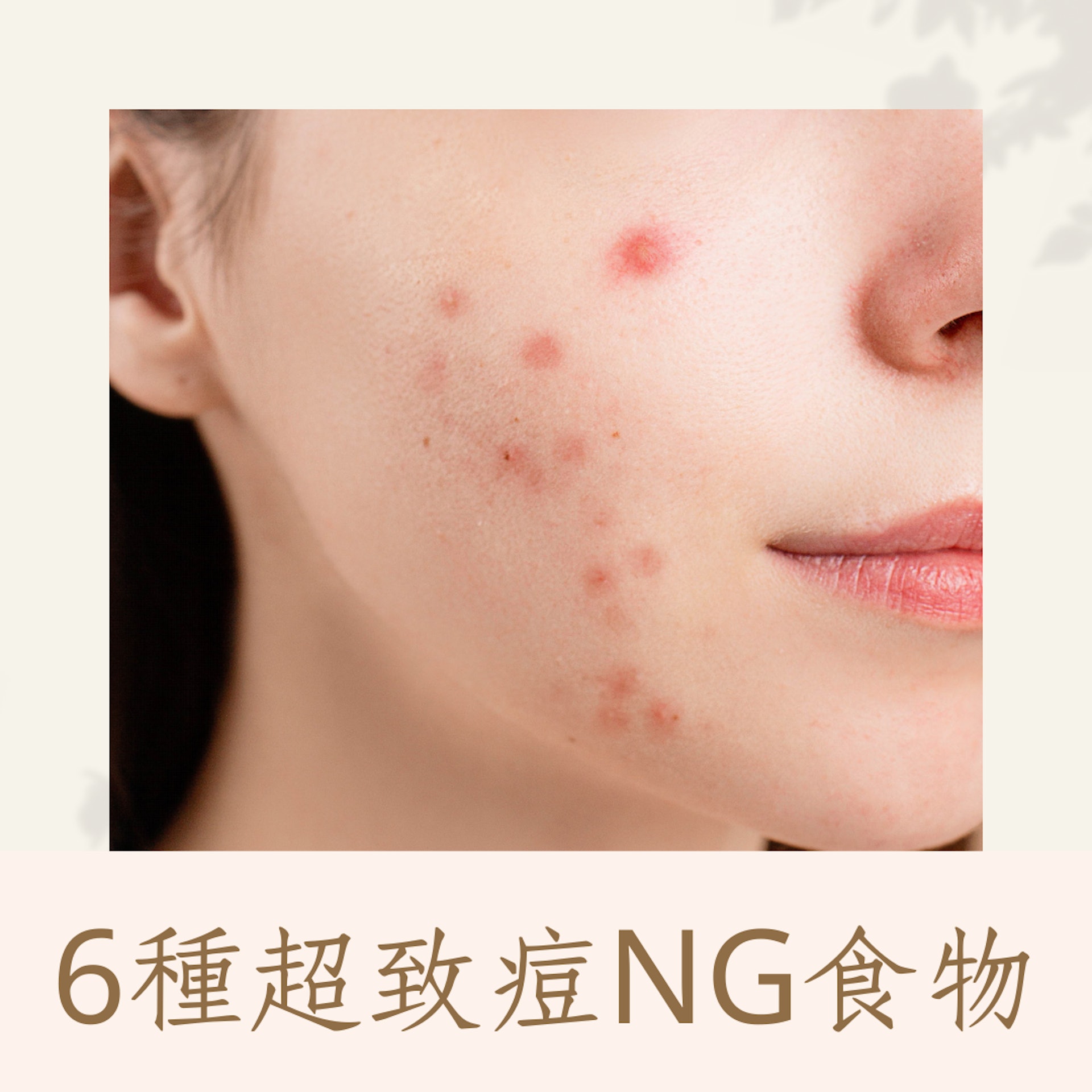 6種超致痘NG食物(01製圖) 6種超致痘NG食物(01製圖)