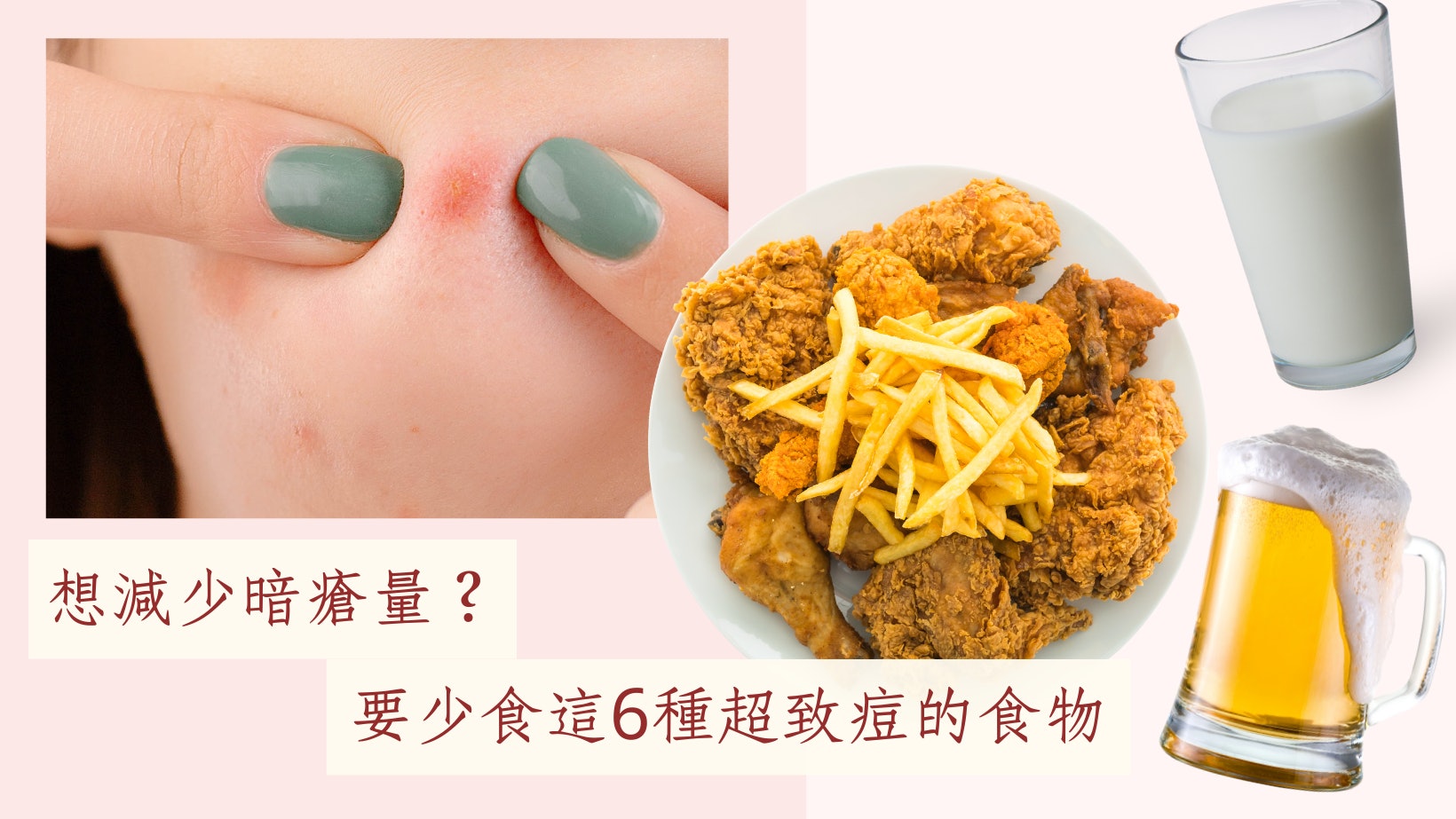 護膚貼士|6種容易導致生暗瘡的食物 不是痘痘肌也要注意免踩雷 護膚貼士|6種容易導致生暗瘡的食物 不是痘痘肌也要注意免踩雷