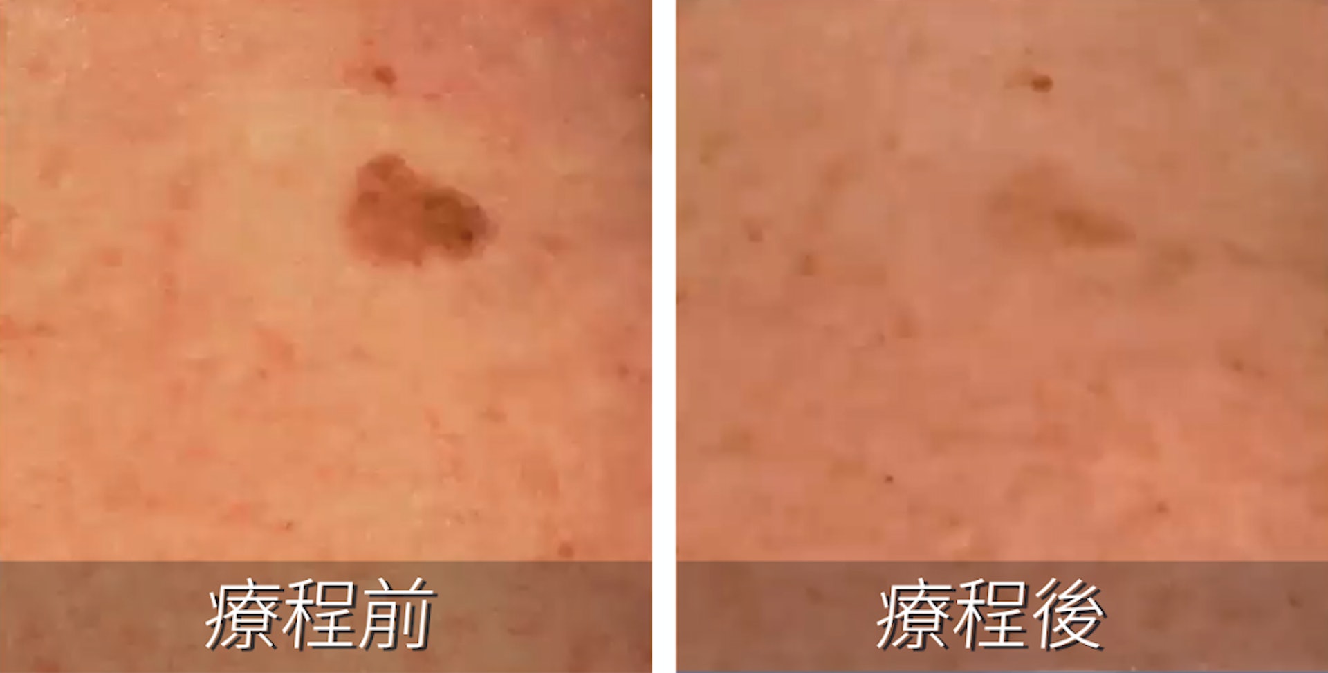 顧客臉上的大塊色斑範圍大為縮小而且顏色減淡,小塊色班更已消失不見。(圖片:Yanis Beauty) 顧客臉上的大塊色斑範圍大為縮小而且顏色減淡,小塊色班更已消失不見。(圖片:Yanis Beauty)