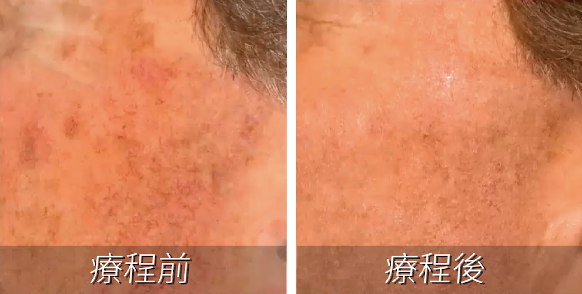 有部分顧客進行療程後不但色斑變淡，而且臉部皮膚因玫瑰挫瘡而導致的脹紅情況亦明顯得以改善。（圖片：Yanis Beauty）