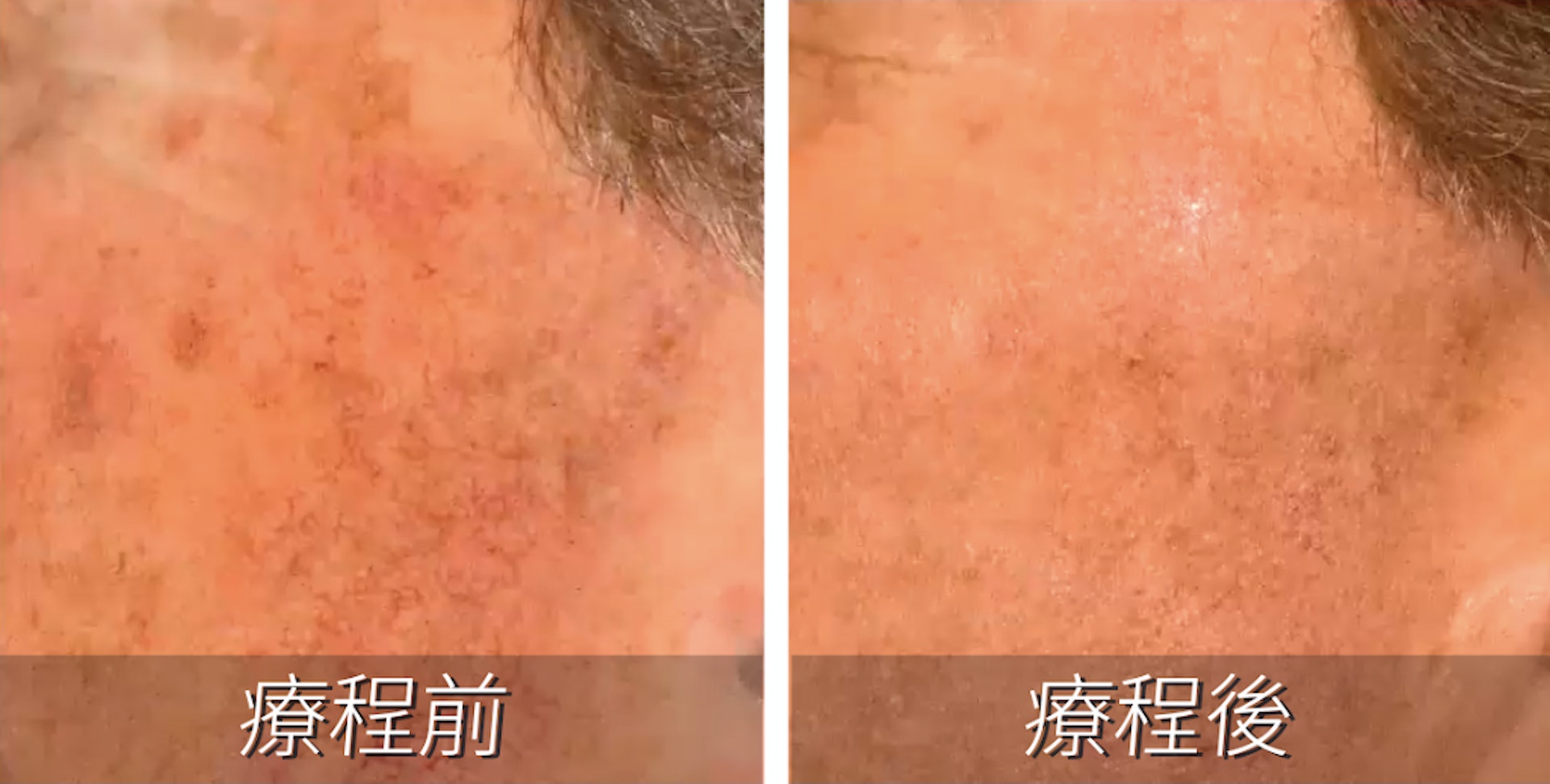 有部分顧客進行療程後不但色斑變淡,而且臉部皮膚因玫瑰挫瘡而導致的脹紅情況亦明顯得以改善。(圖片:Yanis Beauty) 有部分顧客進行療程後不但色斑變淡,而且臉部皮膚因玫瑰挫瘡而導致的脹紅情況亦明顯得以改善。(圖片:Yanis Beauty)