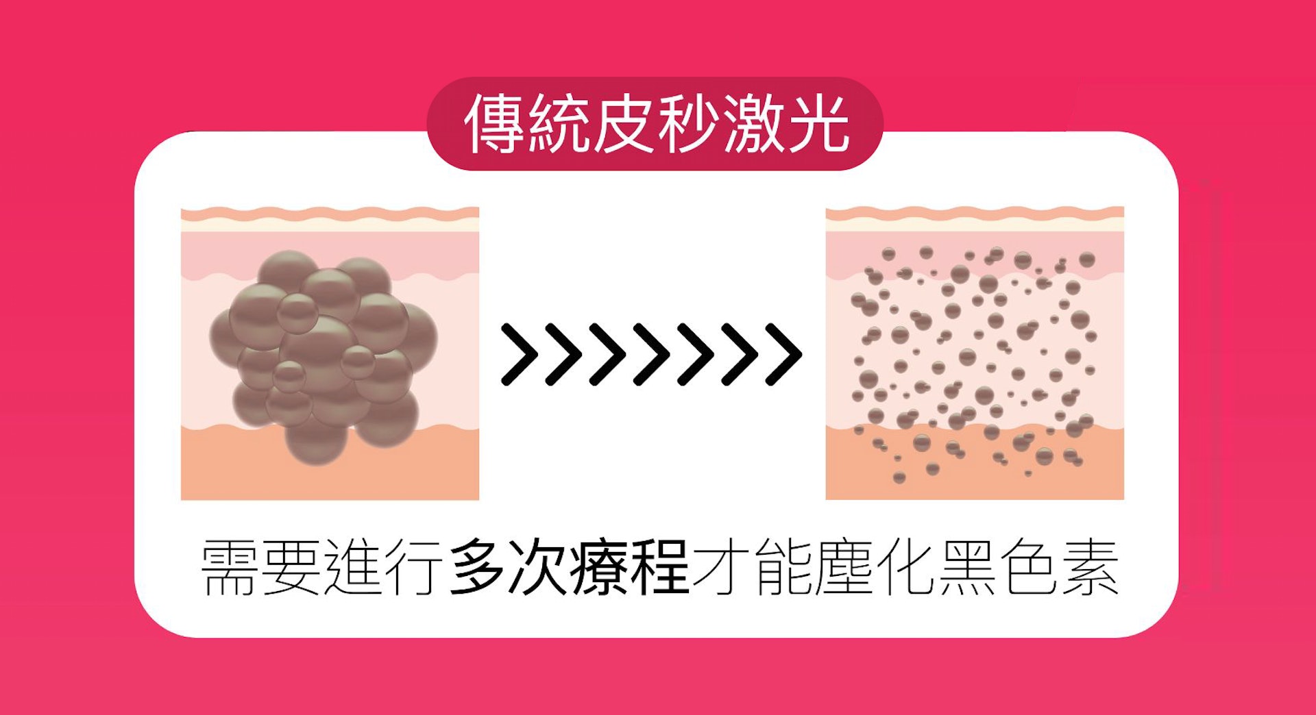 黑色素的體積太大,就算經過傳統皮秒激光震擊後,亦未必能完全被粉碎;有機會需要多次療程才能成功塵化,因此削弱袪斑效果。(圖片:JC Beauty) 黑色素的體積太大,就算經過傳統皮秒激光震擊後,亦未必能完全被粉碎;有機會需要多次療程才能成功塵化,因此削弱袪斑效果。(圖片:JC Beauty)