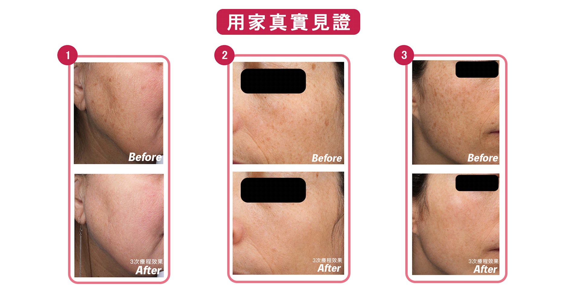 JC Beauty治療師根據客人不同的皮膚狀態和問題，進行個人定制袪斑，治療效果已獲得很多用家的好評。（圖片：JC Beauty）