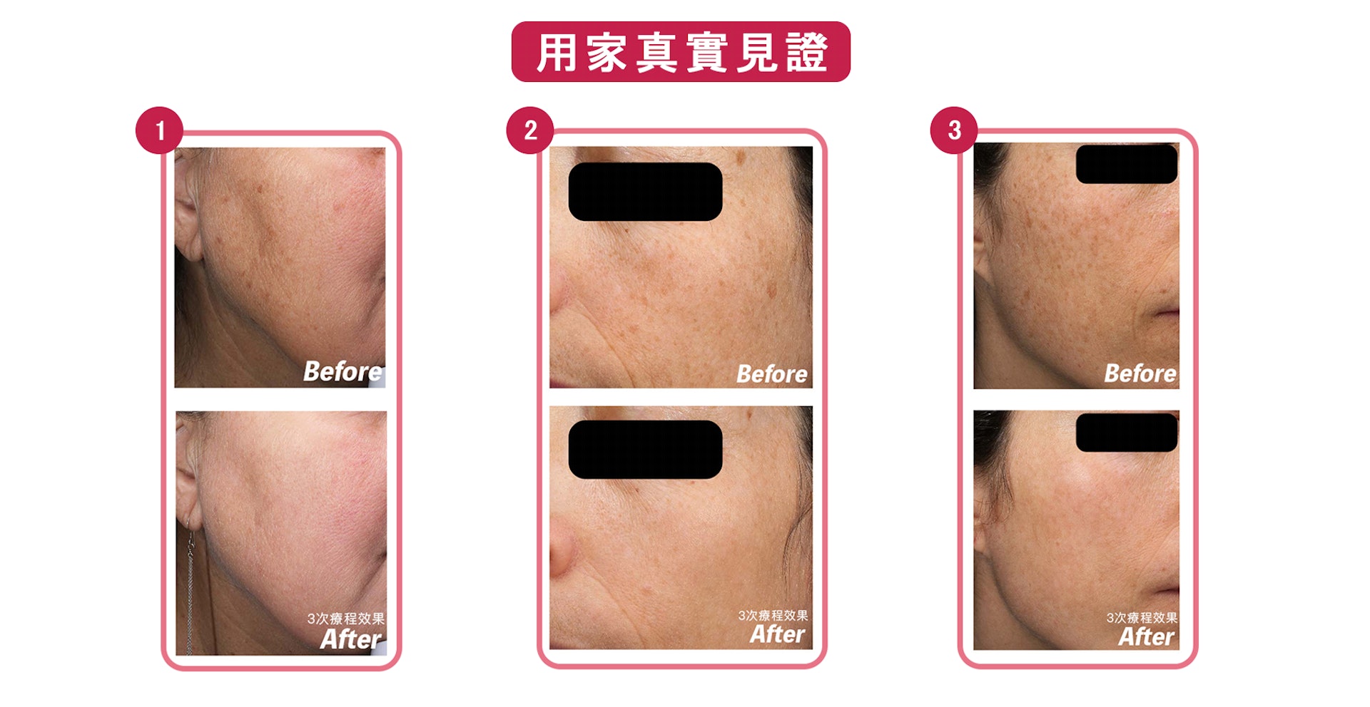 JC Beauty治療師根據客人不同的皮膚狀態和問題,進行個人定制袪斑,治療效果已獲得很多用家的好評。(圖片:JC Beauty) JC Beauty治療師根據客人不同的皮膚狀態和問題,進行個人定制袪斑,治療效果已獲得很多用家的好評。(圖片:JC Beauty)
