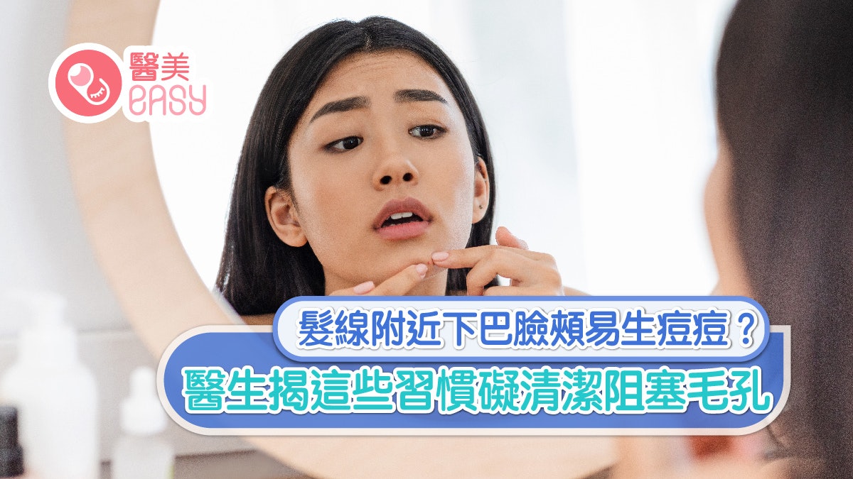 護膚|髮線附近下巴臉頰易生痘痘?醫生揭這些習慣礙清潔阻塞毛孔 護膚|髮線附近下巴臉頰易生痘痘?醫生揭這些習慣礙清潔阻塞毛孔