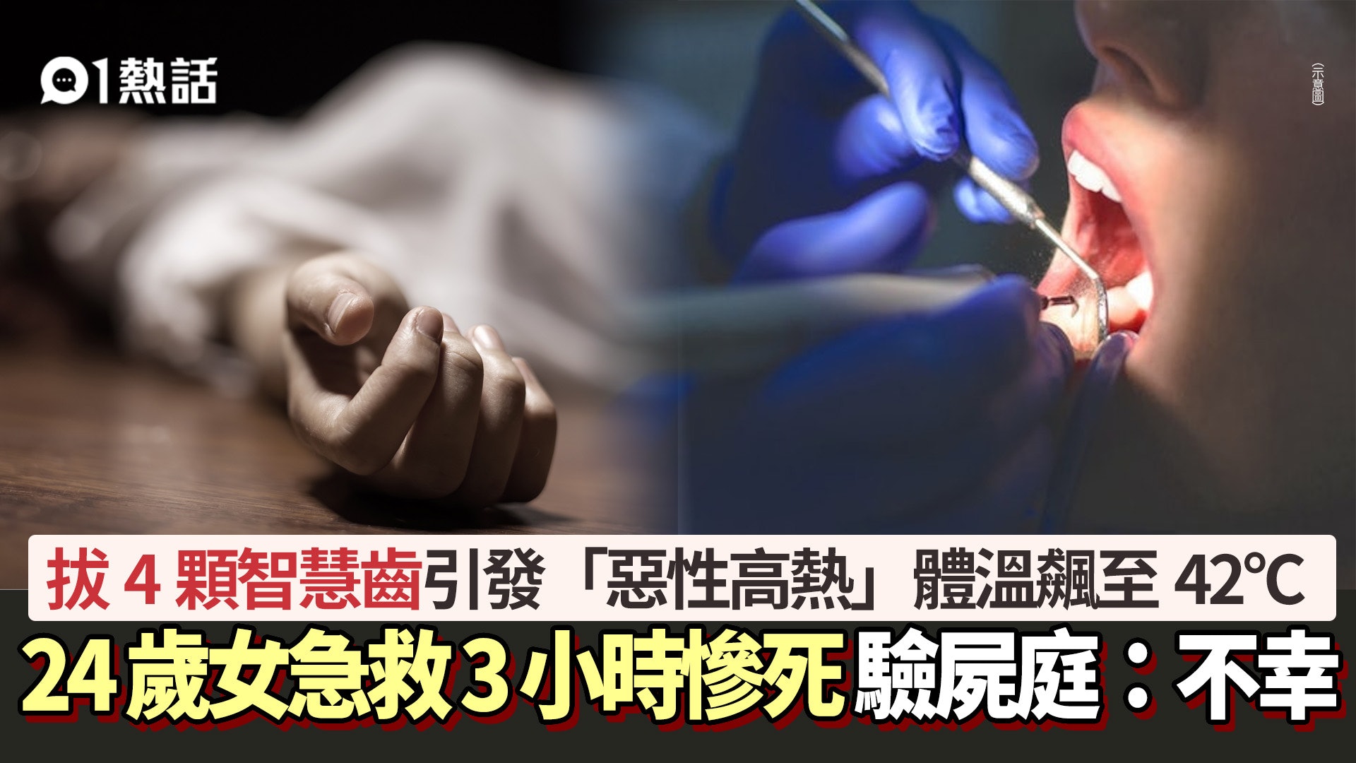 剝牙悲劇!24歲女拔4顆智慧齒引發「惡性高熱」 急救3小時慘死 剝牙悲劇!24歲女拔4顆智慧齒引發「惡性高熱」 急救3小時慘死