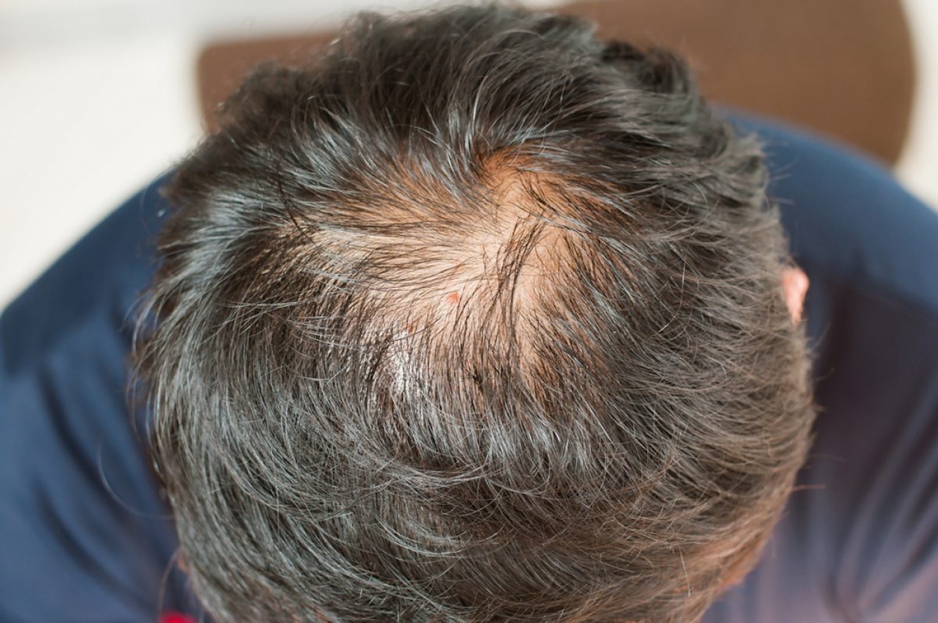 中年人士髮量逐漸減少，基本上與氣血、腎氣虧損等生理因素有關。（圖片：Shutterstock）